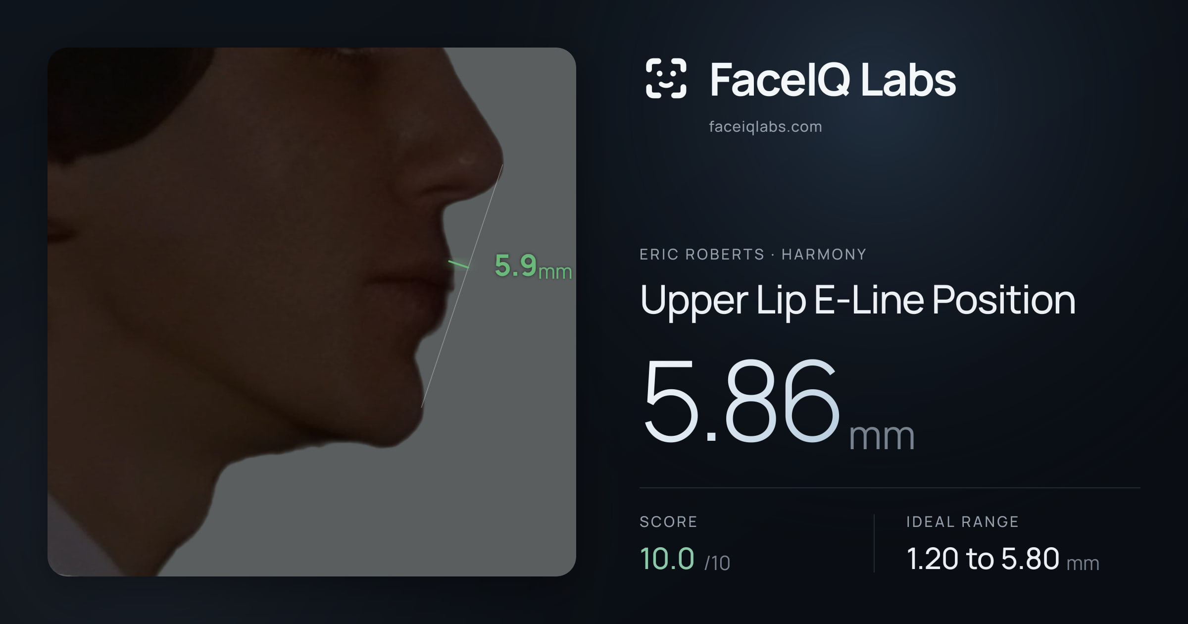 Eric Roberts Upper Lip E-Line Position: 5.86mm, drawn on the photo