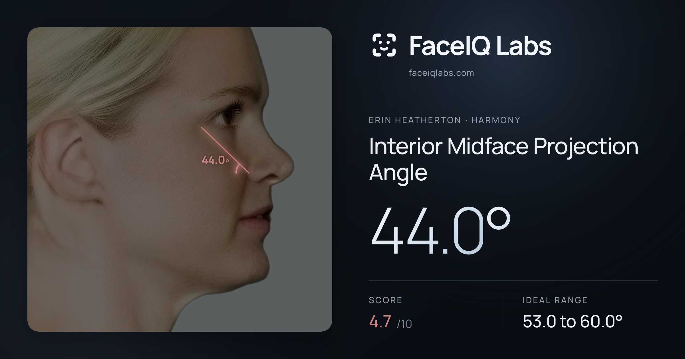 Erin Heatherton Interior Midface Projection Angle: 44.0°, drawn on the photo