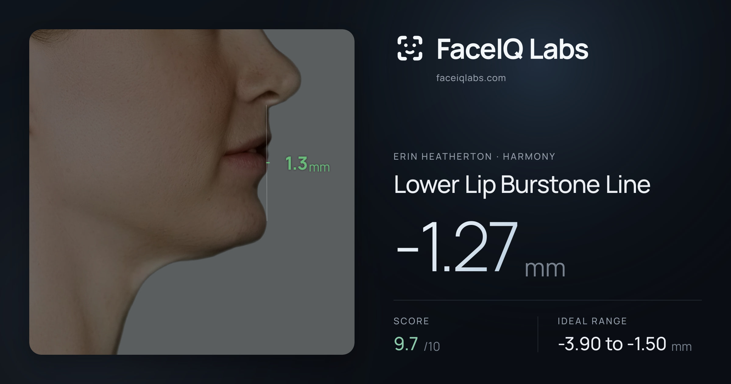 Erin Heatherton Lower Lip Burstone Line: -1.27mm, drawn on the photo