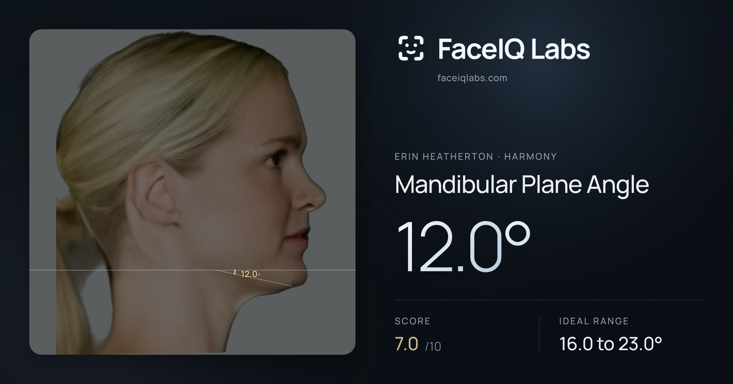 Erin Heatherton Mandibular Plane Angle: 12.0°, drawn on the photo