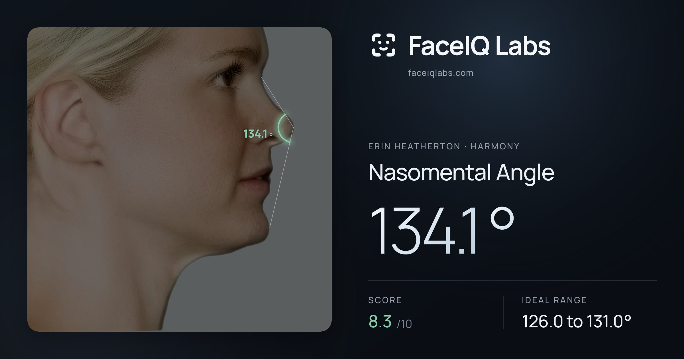 Erin Heatherton Nasomental Angle: 134.1°, drawn on the photo