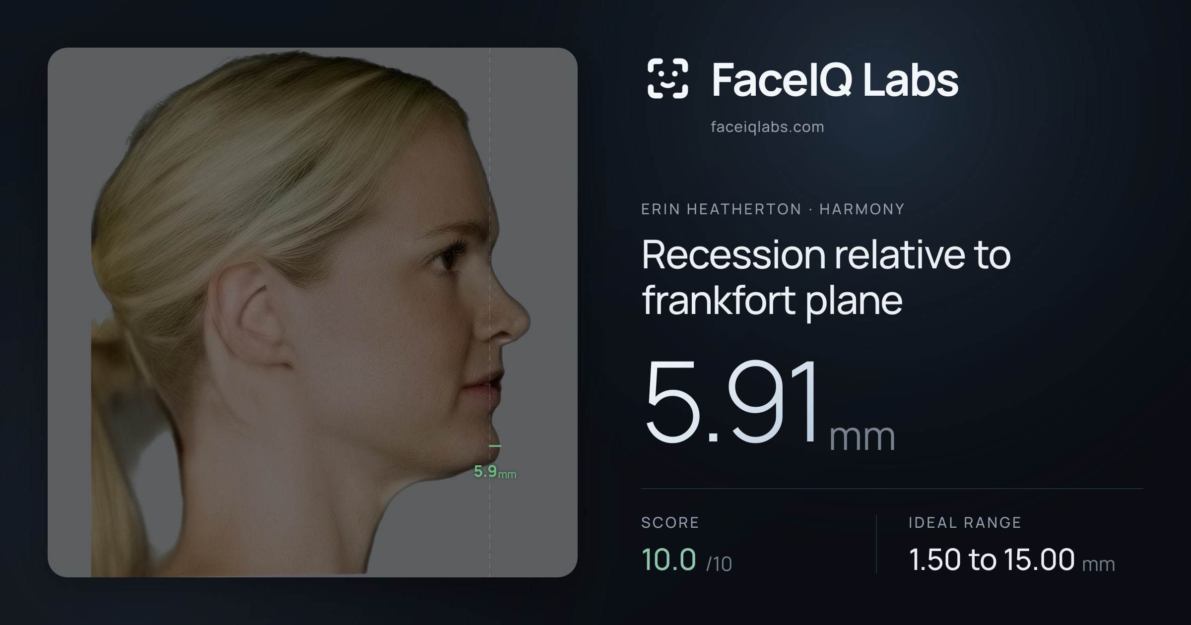 Erin Heatherton Recession relative to frankfort plane: 5.91mm, drawn on the photo