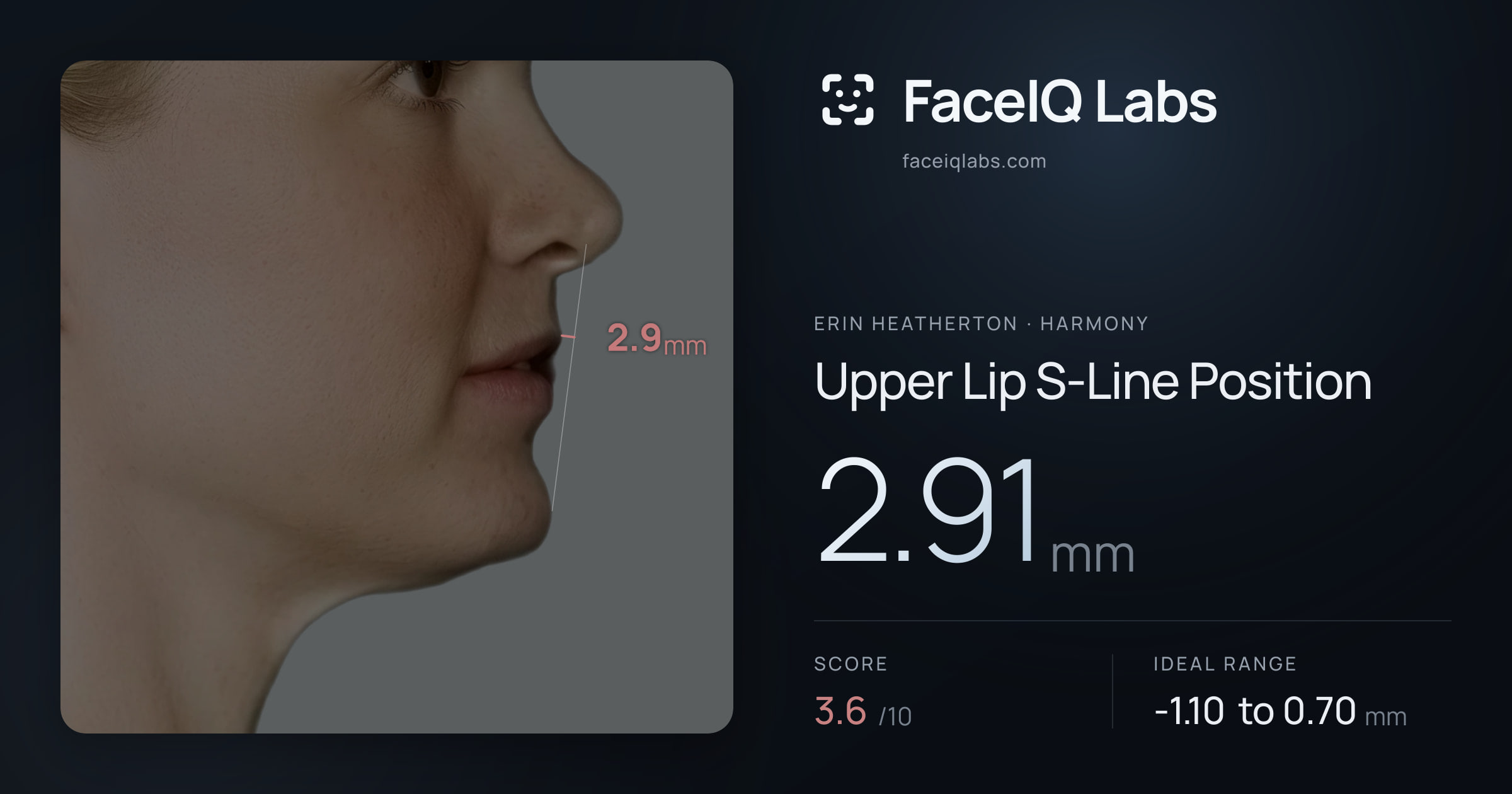 Erin Heatherton Upper Lip S-Line Position: 2.91mm, drawn on the photo
