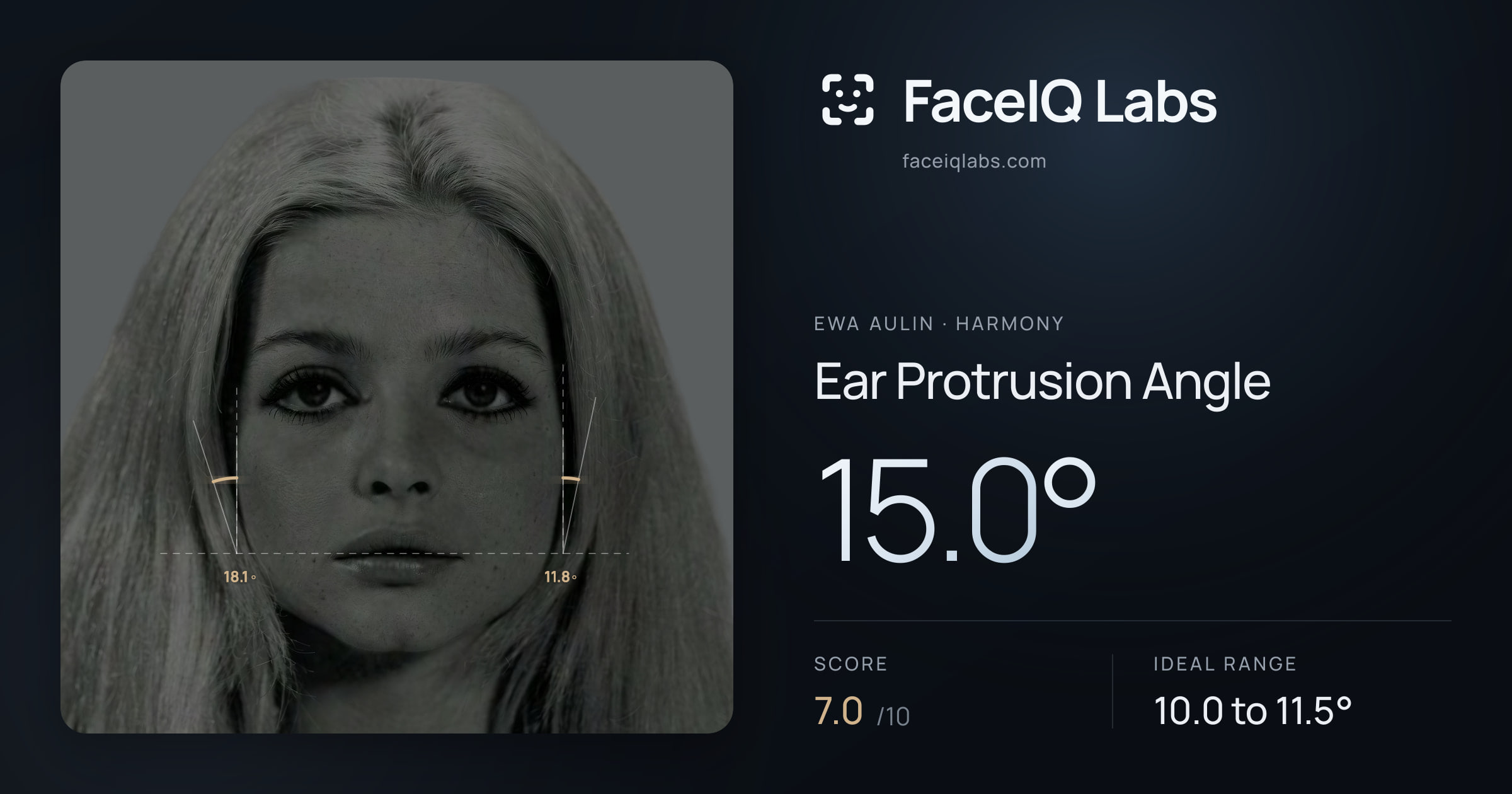 Ewa Aulin Ear Protrusion Angle: 15.0°, drawn on the photo