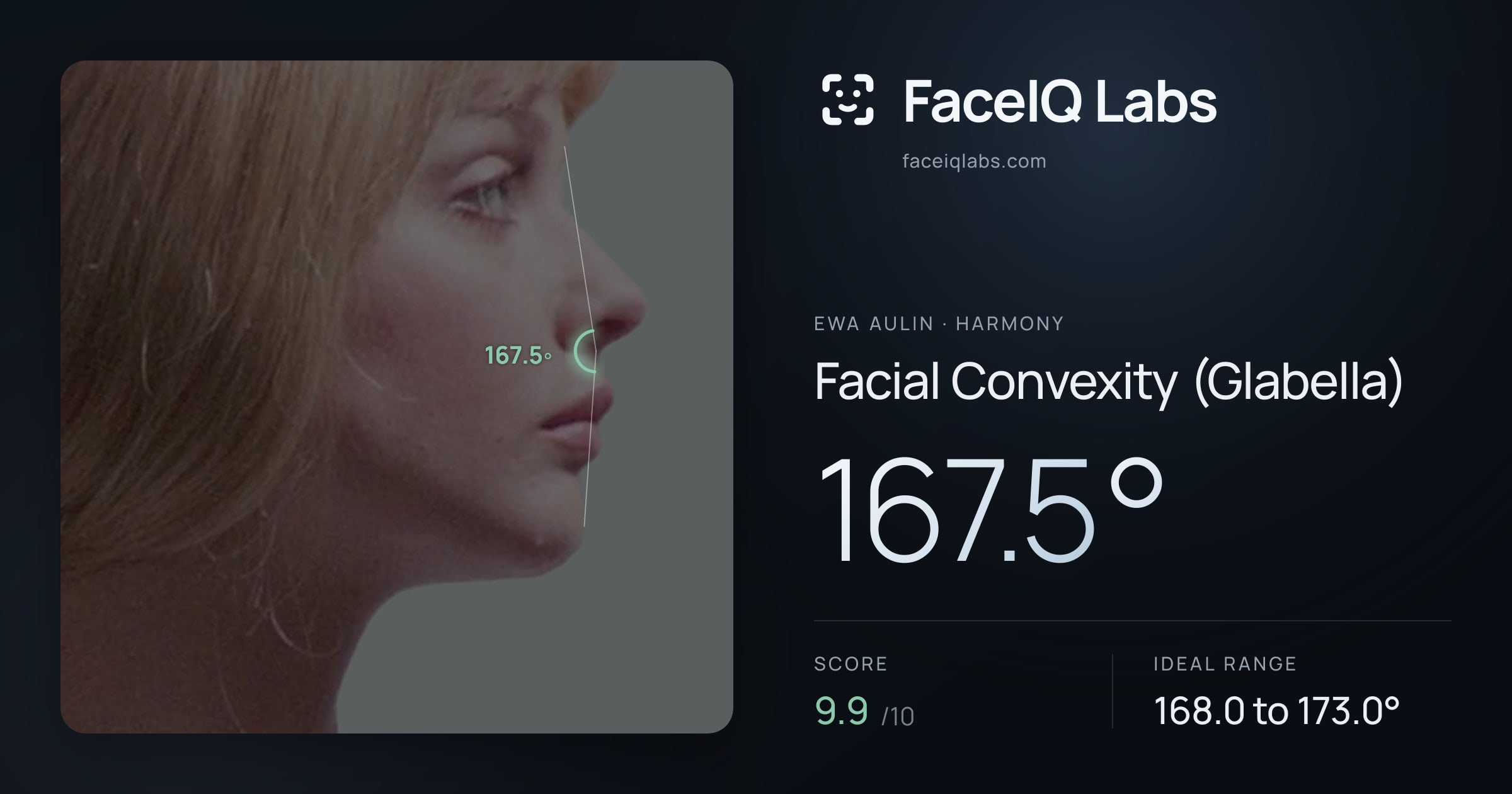 Ewa Aulin Facial Convexity (Glabella): 167.5°, drawn on the photo