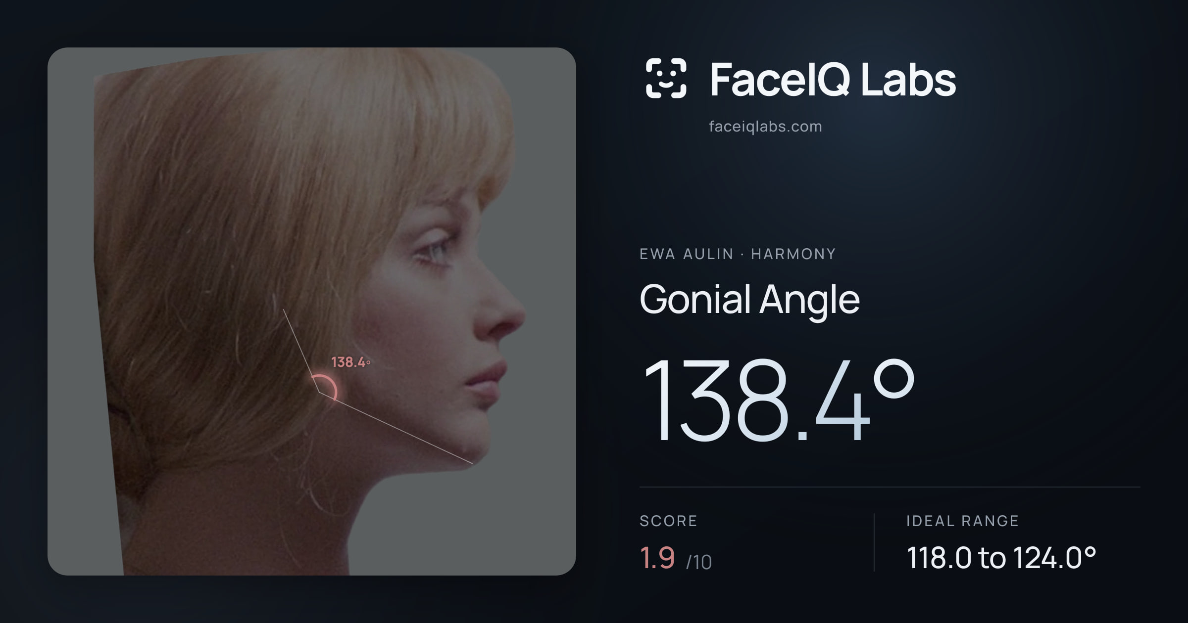 Ewa Aulin Gonial Angle: 138.4°, drawn on the photo