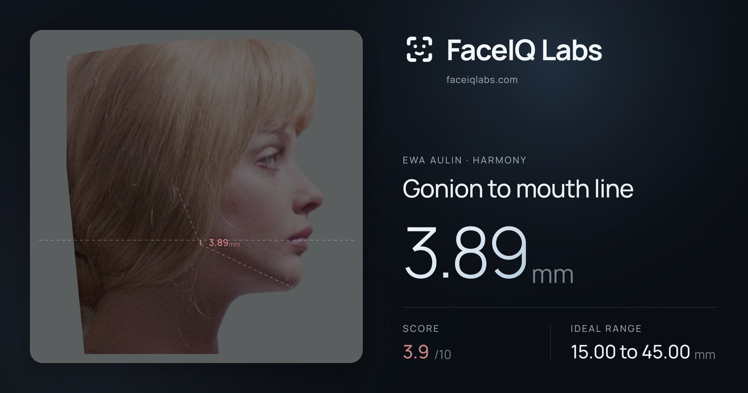 Ewa Aulin Gonion to mouth line: 3.89mm, drawn on the photo
