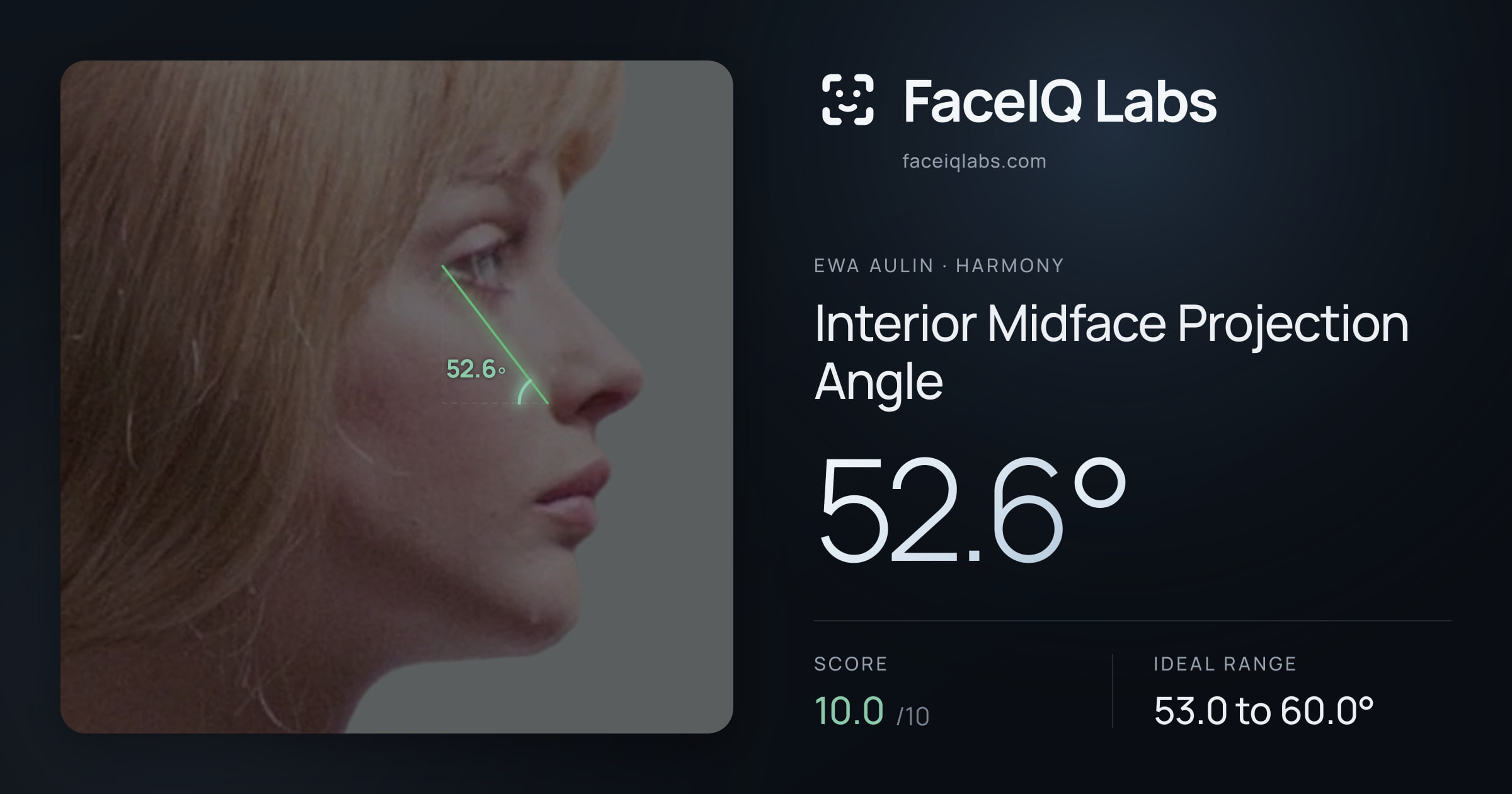 Ewa Aulin Interior Midface Projection Angle: 52.6°, drawn on the photo