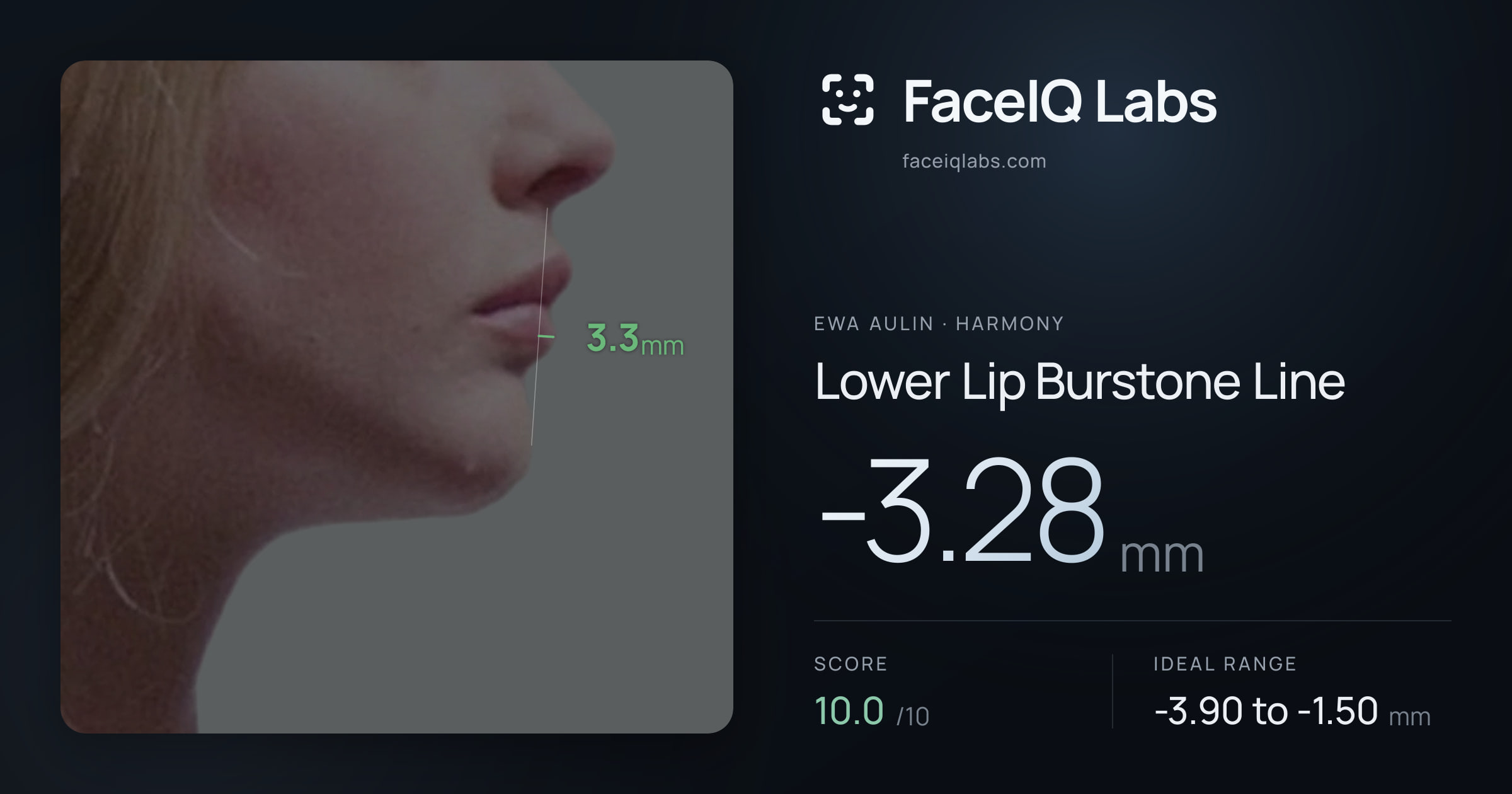 Ewa Aulin Lower Lip Burstone Line: -3.28mm, drawn on the photo