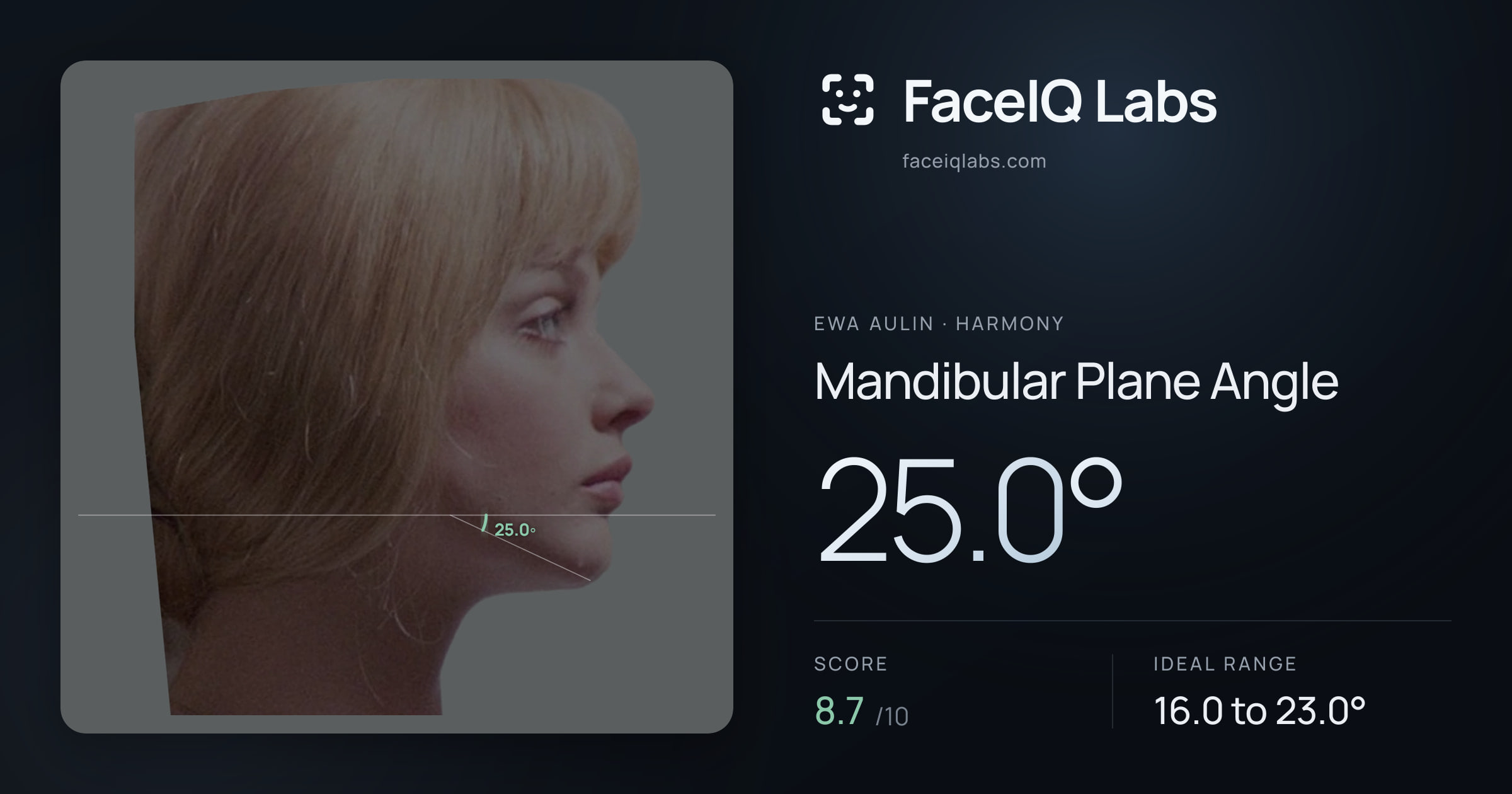 Ewa Aulin Mandibular Plane Angle: 25.0°, drawn on the photo