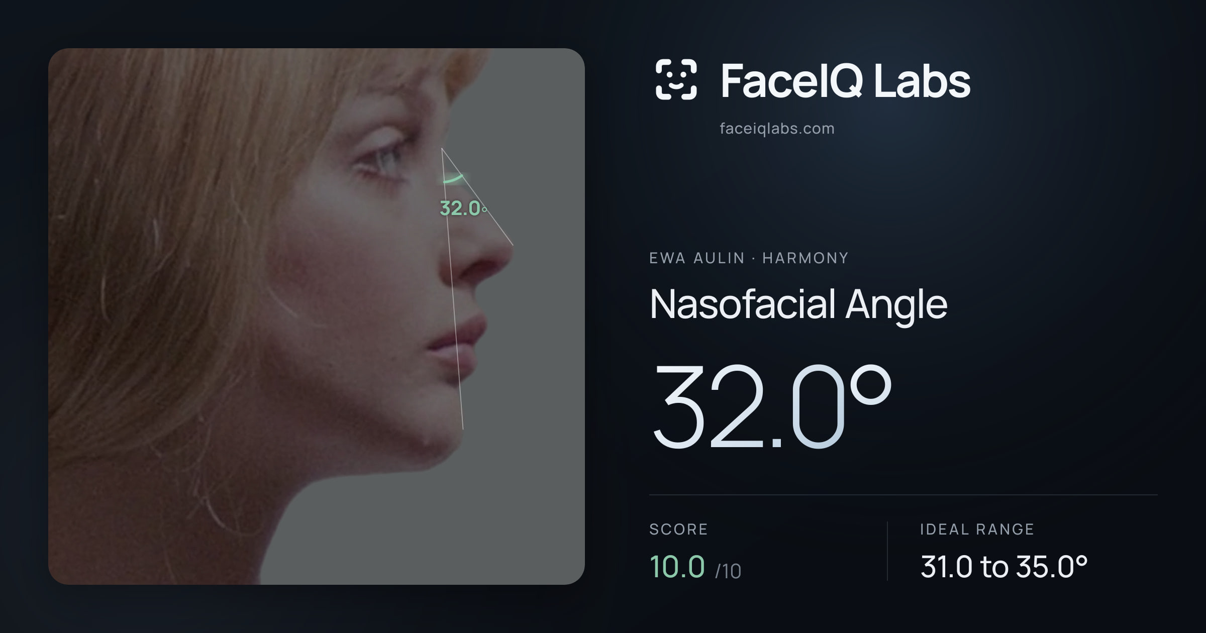 Ewa Aulin Nasofacial Angle: 32.0°, drawn on the photo