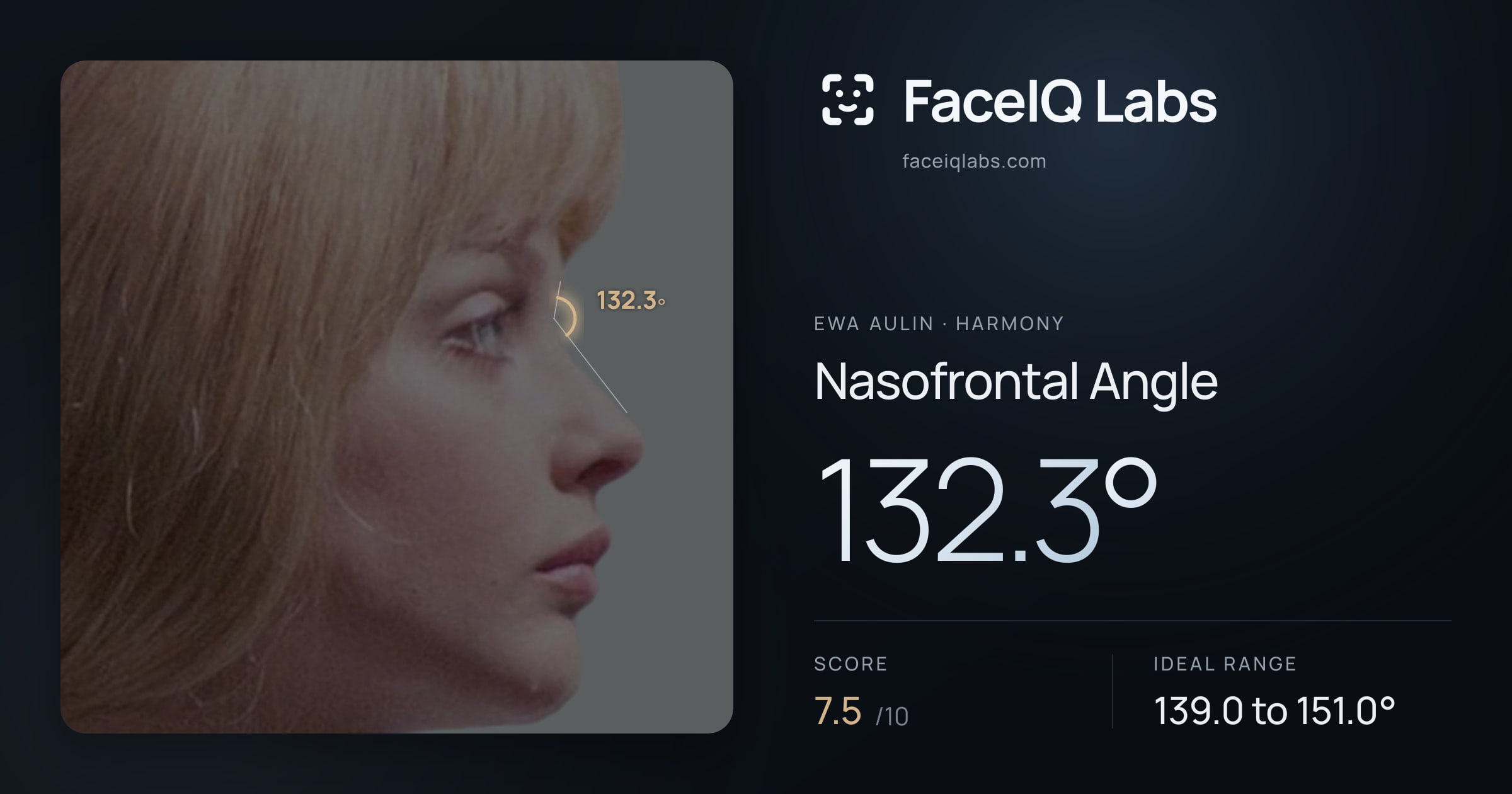 Ewa Aulin Nasofrontal Angle: 132.3°, drawn on the photo