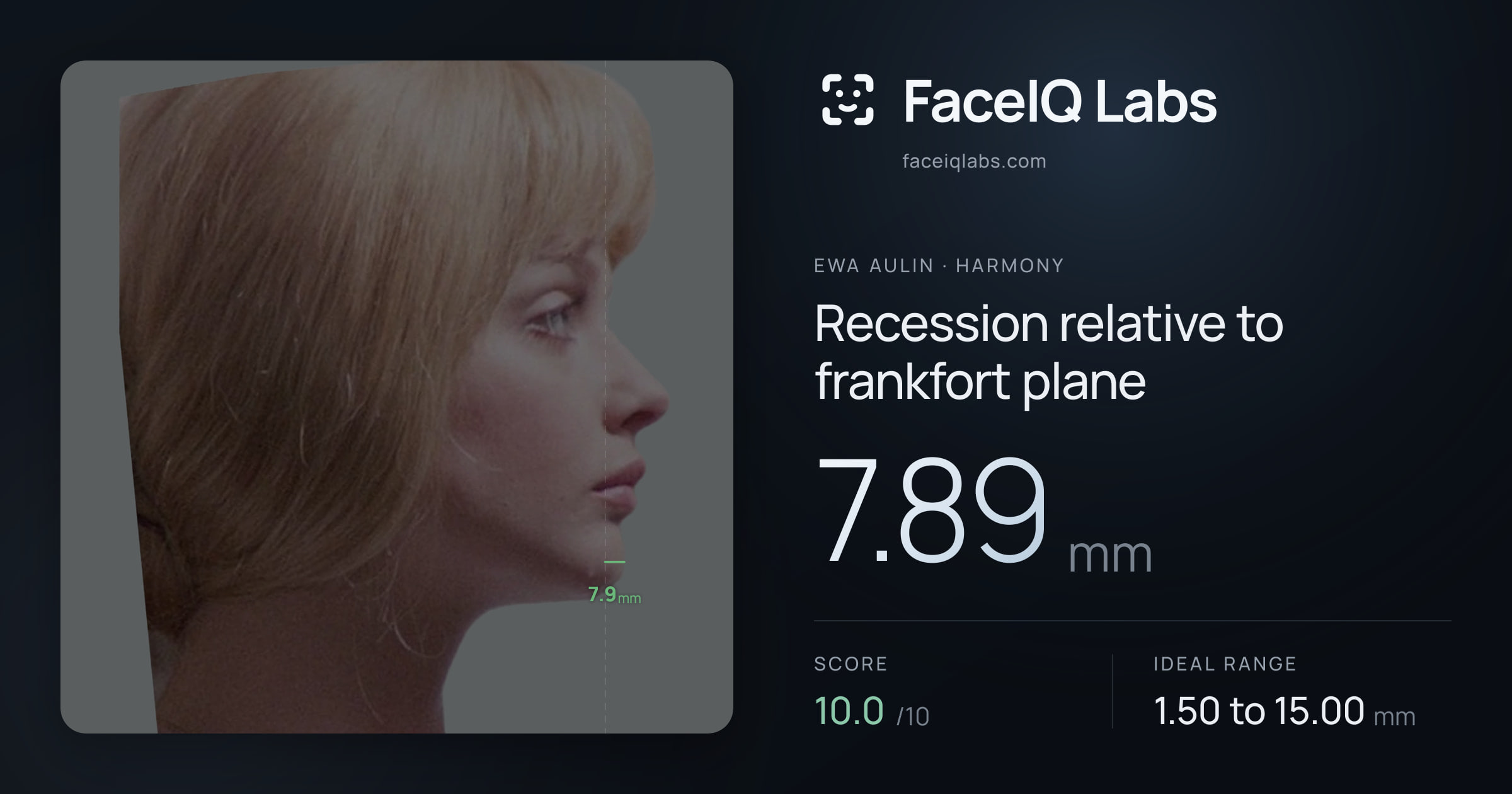Ewa Aulin Recession relative to frankfort plane: 7.89mm, drawn on the photo