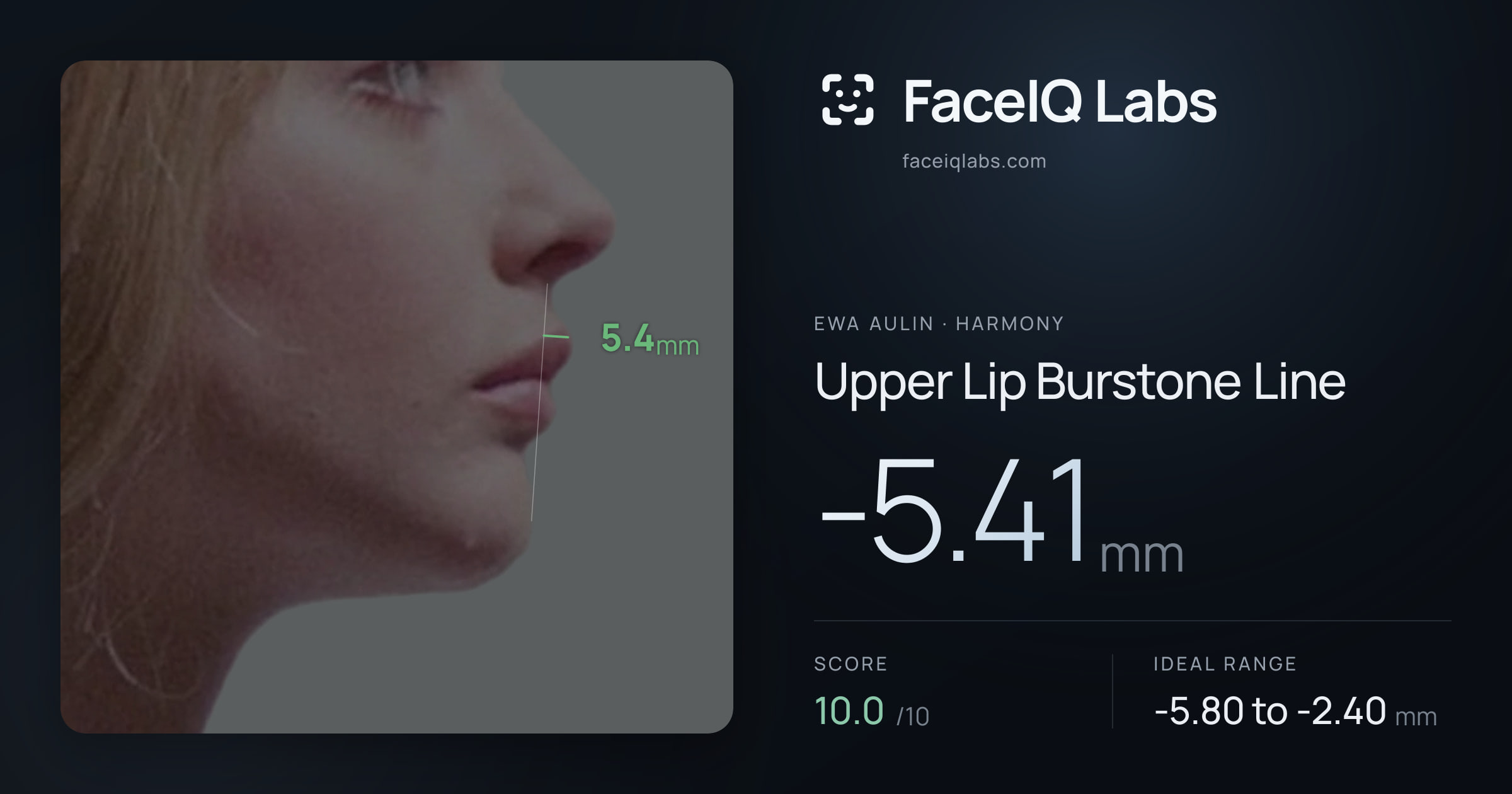 Ewa Aulin Upper Lip Burstone Line: -5.41mm, drawn on the photo