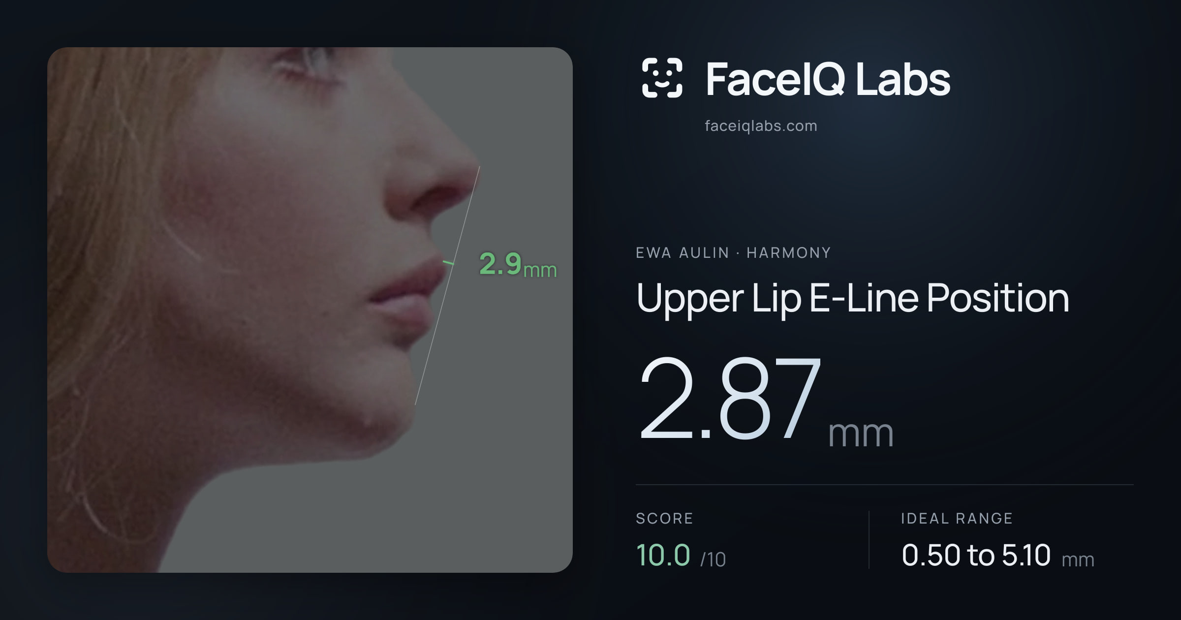 Ewa Aulin Upper Lip E-Line Position: 2.87mm, drawn on the photo