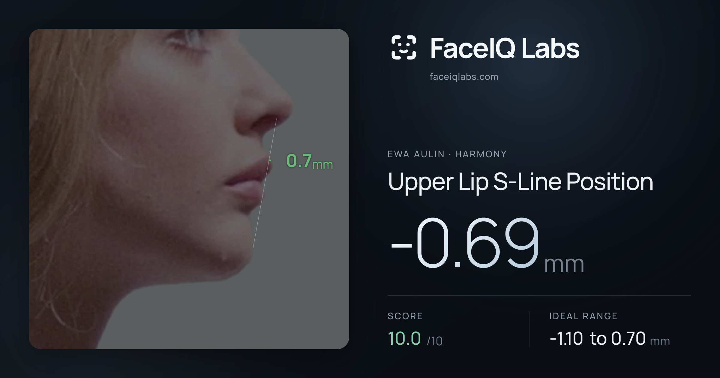 Ewa Aulin Upper Lip S-Line Position: -0.69mm, drawn on the photo