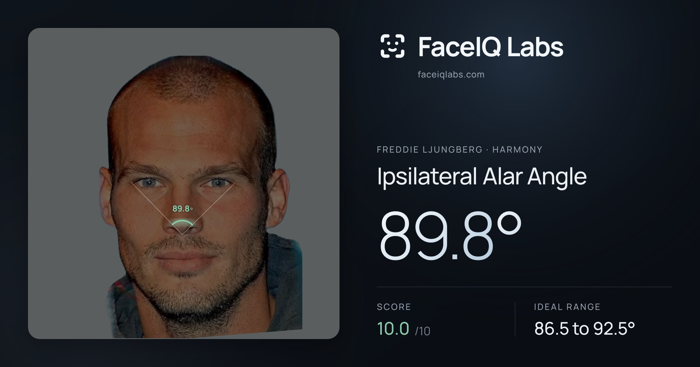 Freddie Ljungberg Ipsilateral Alar Angle: 89.8°, drawn on the photo