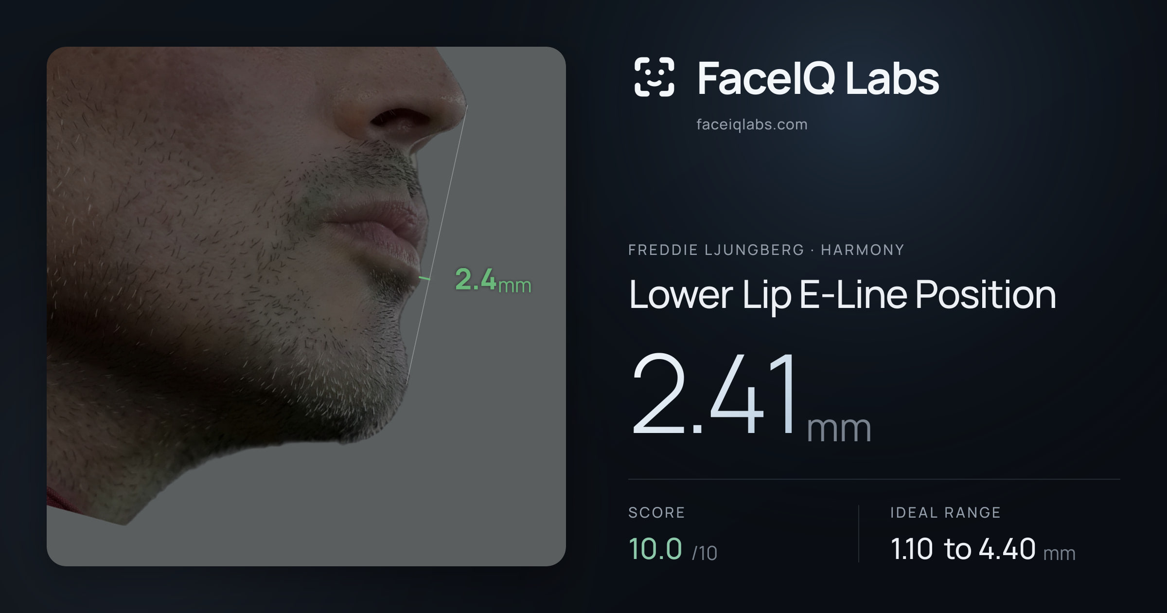 Freddie Ljungberg Lower Lip E-Line Position: 2.41mm, drawn on the photo