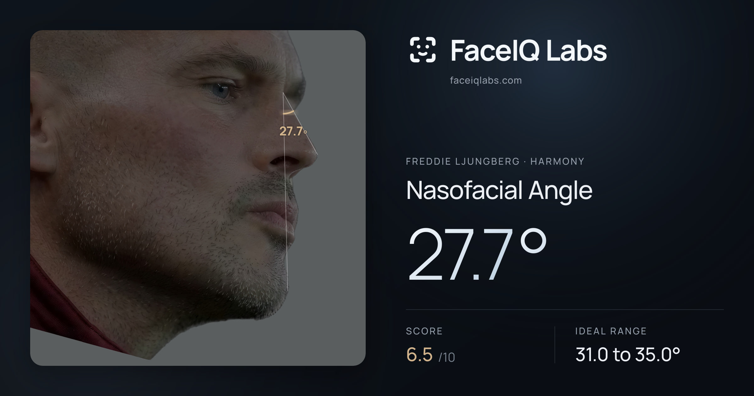 Freddie Ljungberg Nasofacial Angle: 27.7°, drawn on the photo