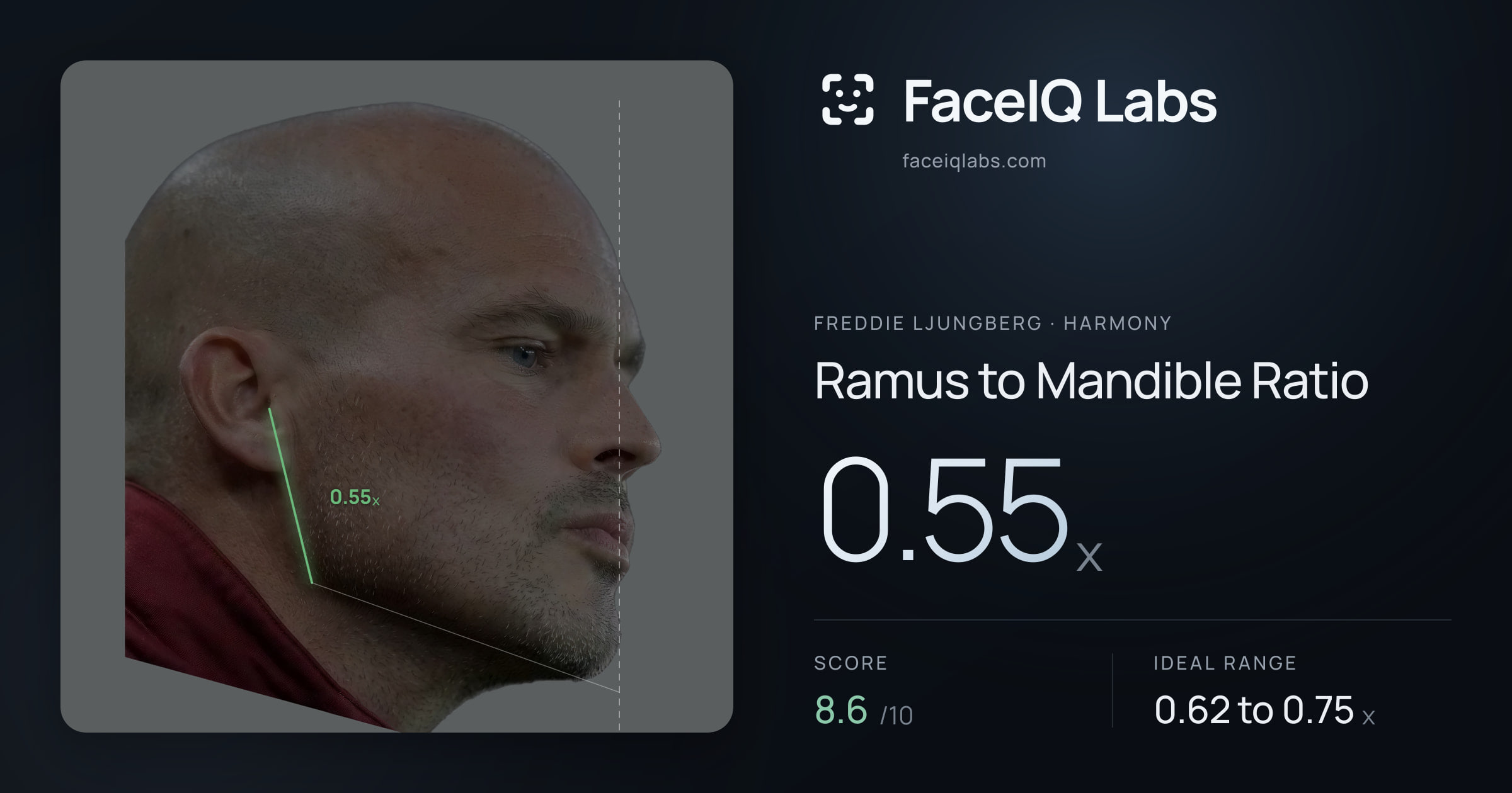 Freddie Ljungberg Ramus to Mandible Ratio: 0.55x, drawn on the photo