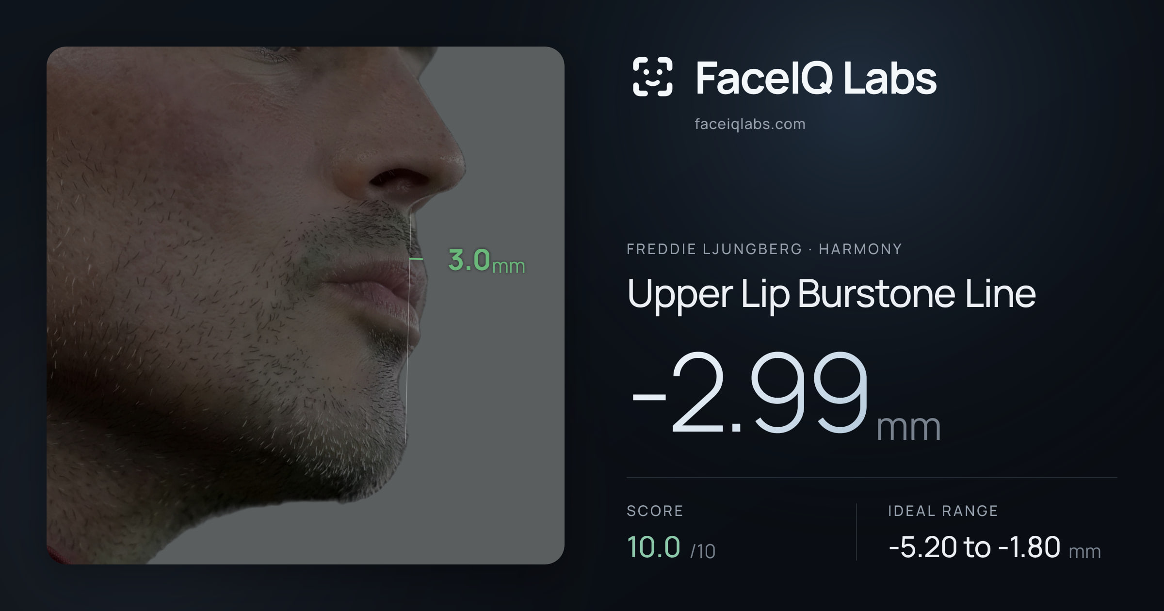 Freddie Ljungberg Upper Lip Burstone Line: -2.99mm, drawn on the photo
