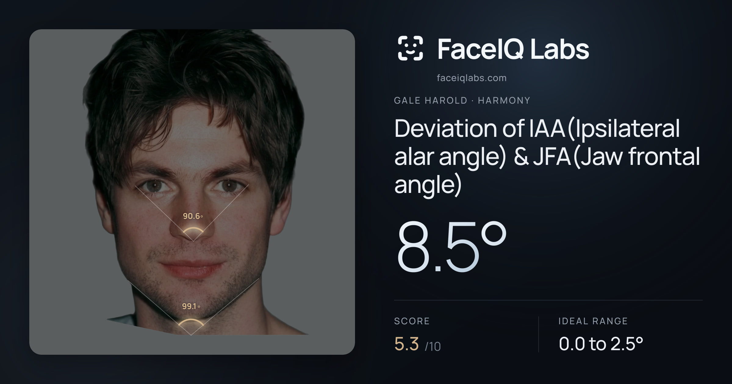 Gale Harold Deviation of IAA(Ipsilateral alar angle) & JFA(Jaw frontal angle): 8.5°, drawn on the photo