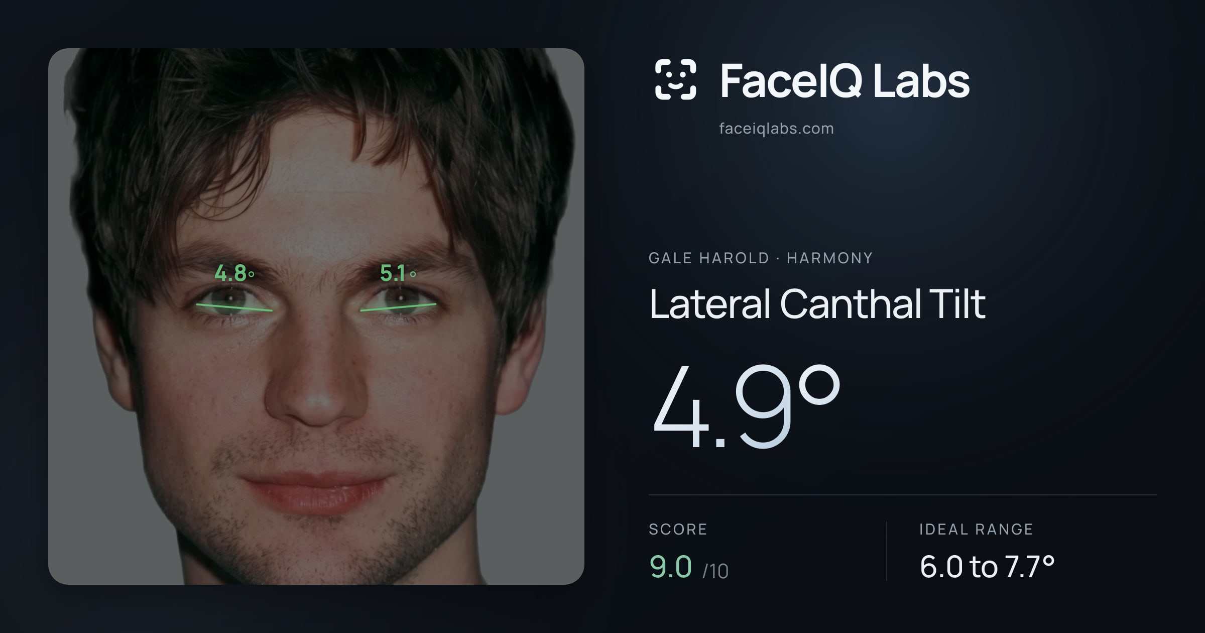 Gale Harold Lateral Canthal Tilt: 4.9°, drawn on the photo