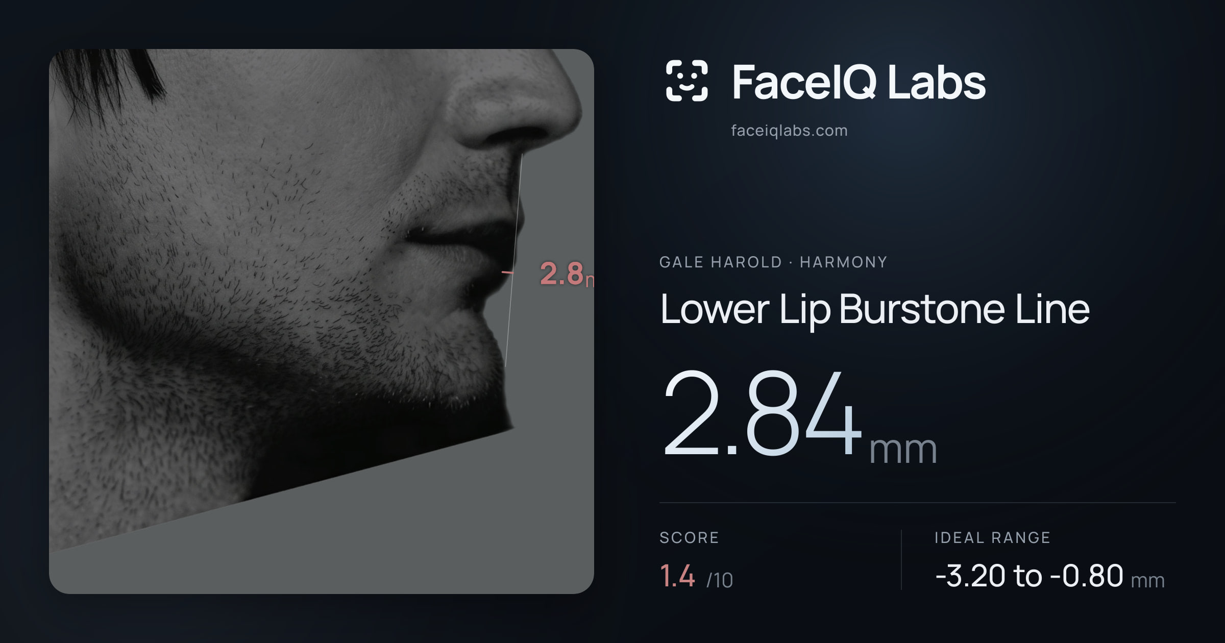 Gale Harold Lower Lip Burstone Line: 2.84mm, drawn on the photo