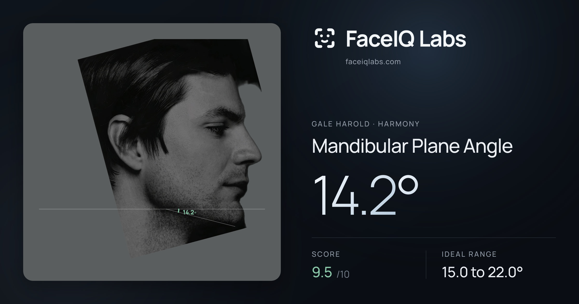 Gale Harold Mandibular Plane Angle: 14.2°, drawn on the photo