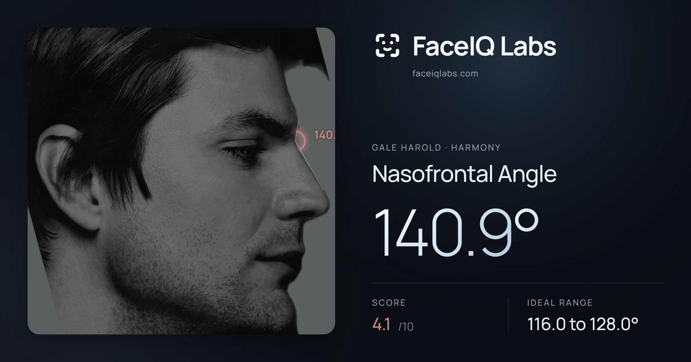 Gale Harold Nasofrontal Angle: 140.9°, drawn on the photo