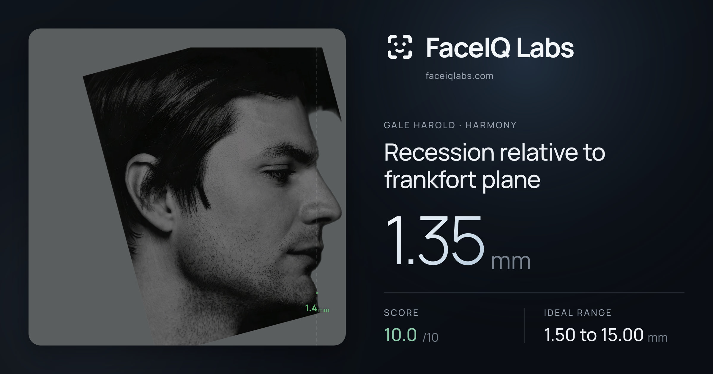 Gale Harold Recession relative to frankfort plane: 1.35mm, drawn on the photo