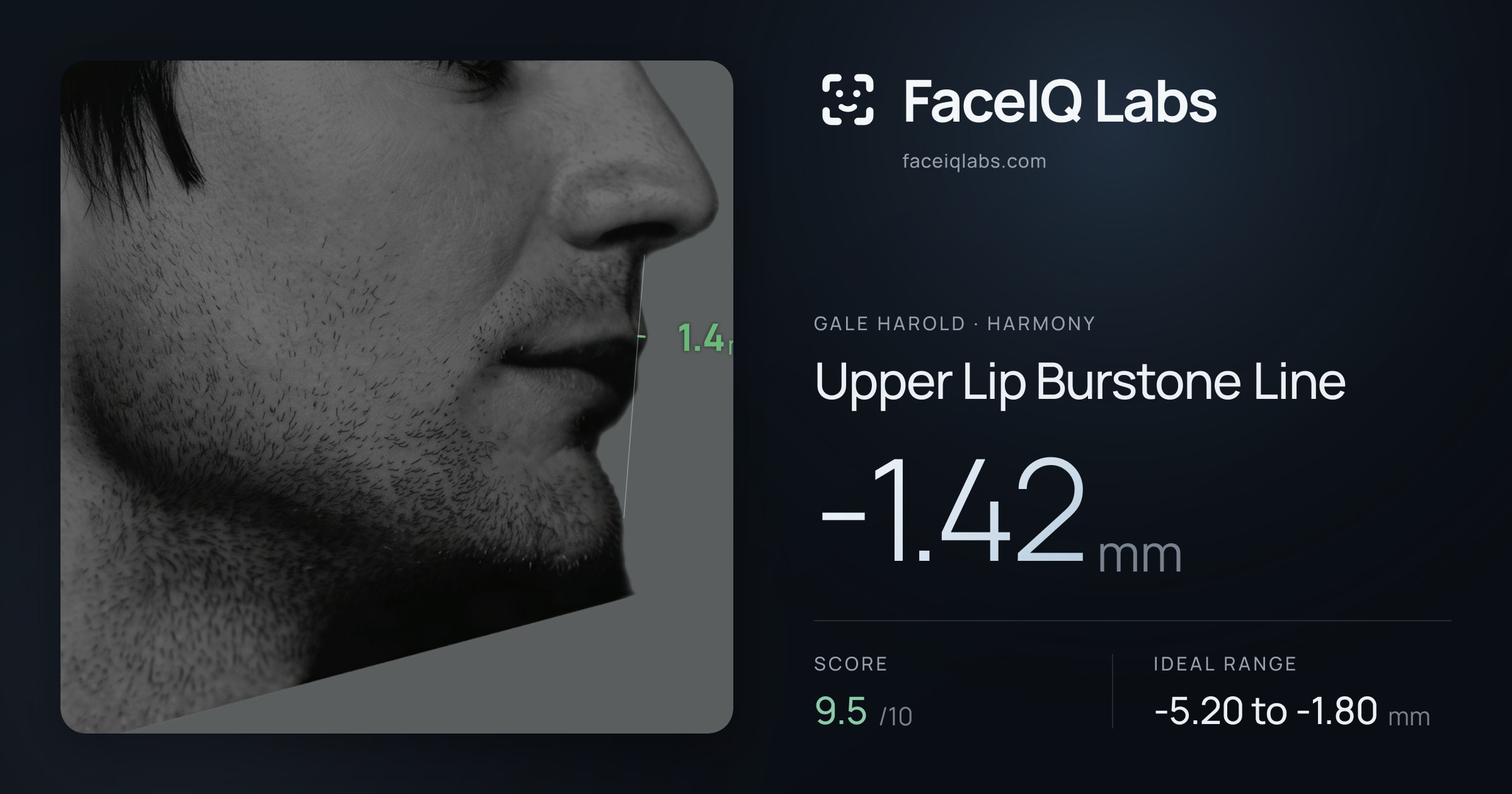 Gale Harold Upper Lip Burstone Line: -1.42mm, drawn on the photo