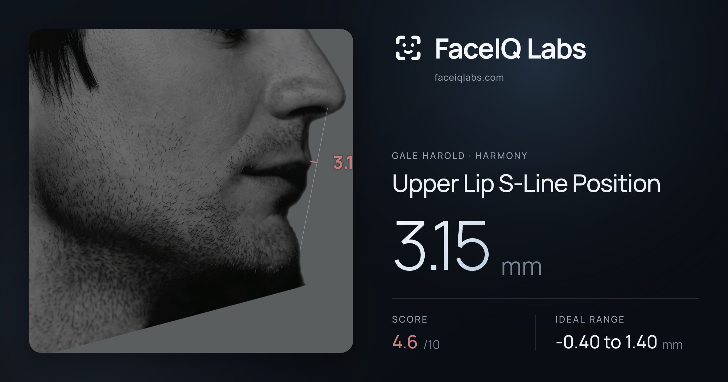 Gale Harold Upper Lip S-Line Position: 3.15mm, drawn on the photo
