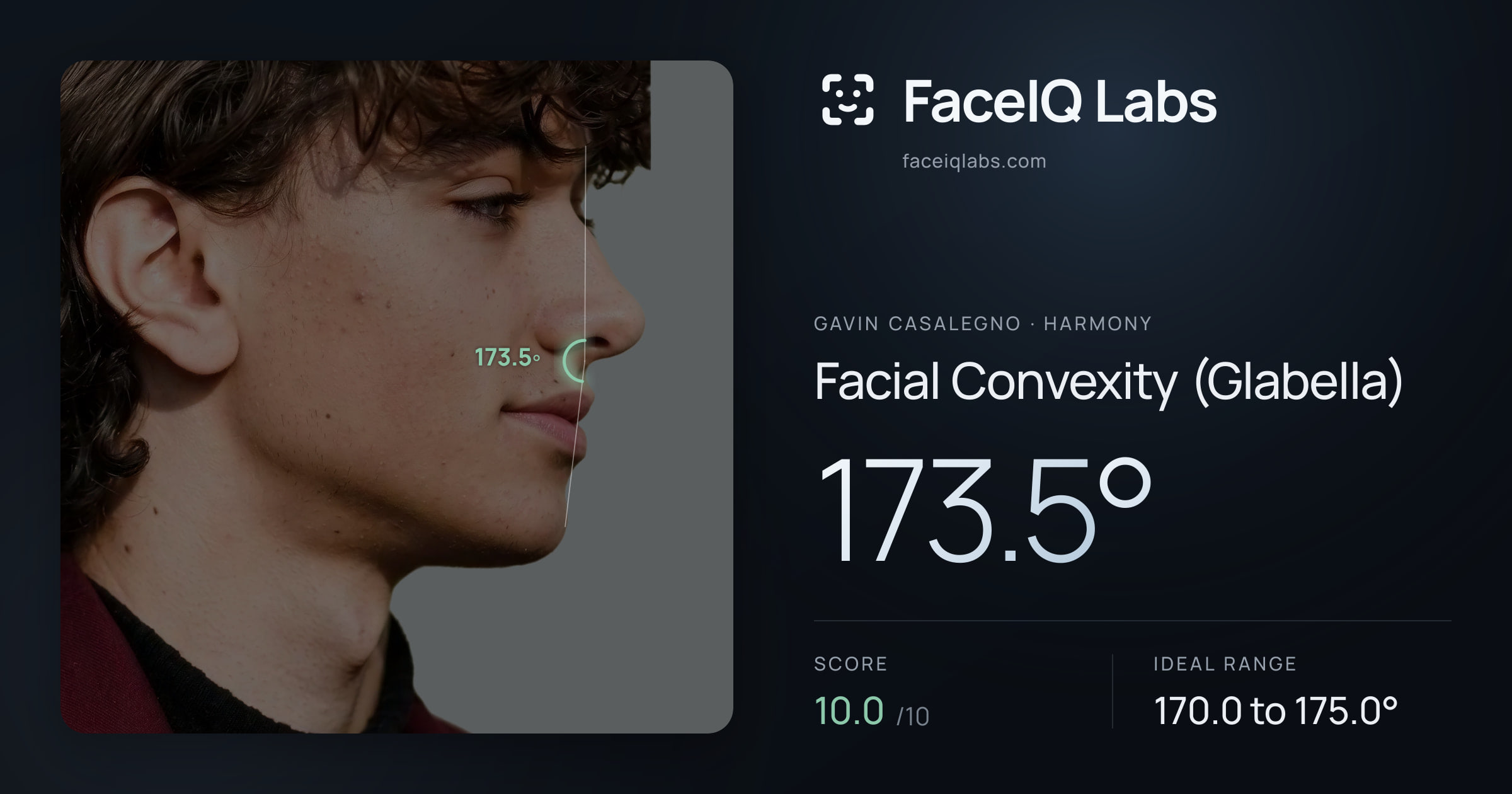 Gavin Casalegno Facial Convexity (Glabella): 173.5°, drawn on the photo