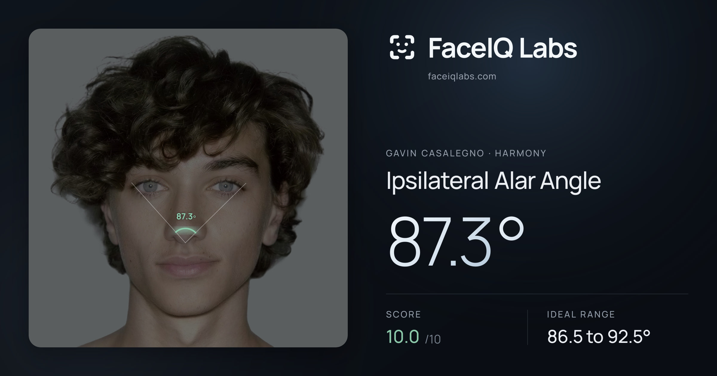 Gavin Casalegno Ipsilateral Alar Angle: 87.3°, drawn on the photo