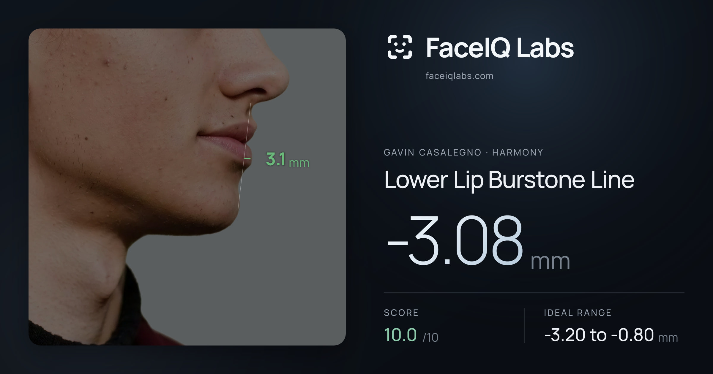 Gavin Casalegno Lower Lip Burstone Line: -3.08mm, drawn on the photo