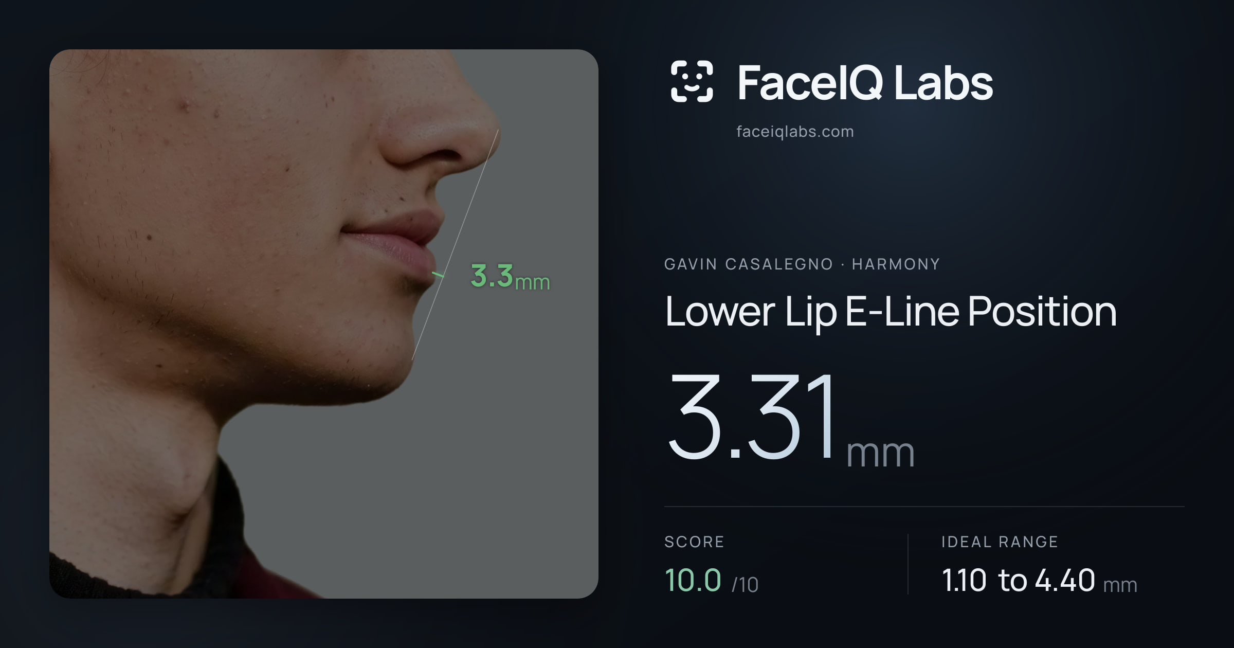Gavin Casalegno Lower Lip E-Line Position: 3.31mm, drawn on the photo