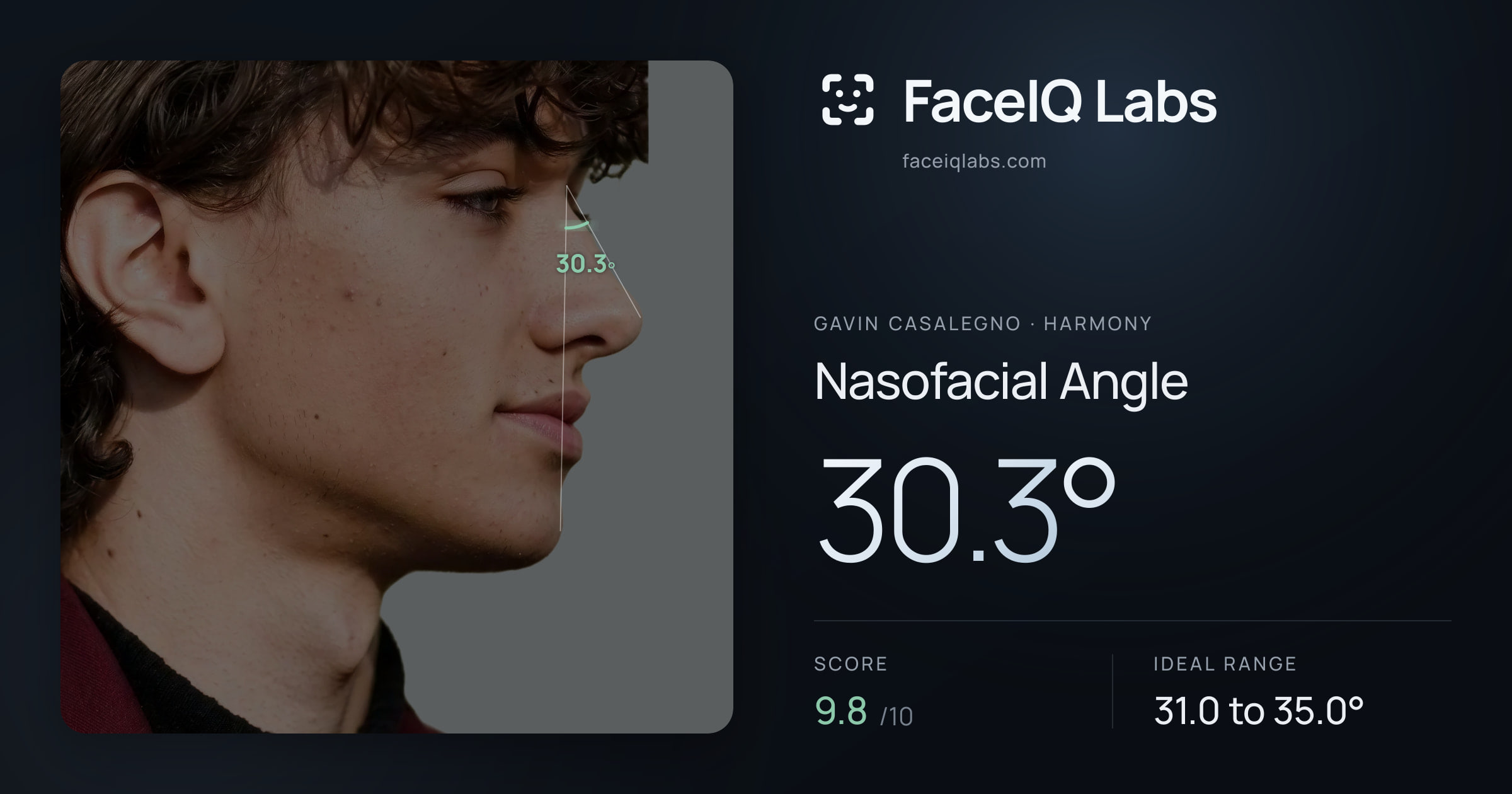 Gavin Casalegno Nasofacial Angle: 30.3°, drawn on the photo
