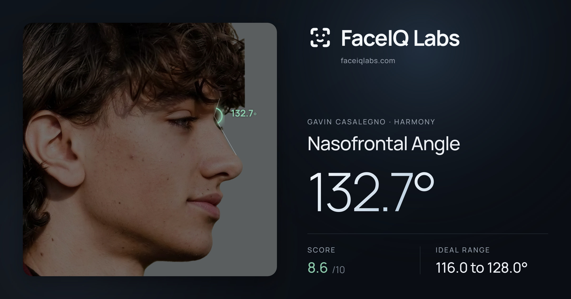 Gavin Casalegno Nasofrontal Angle: 132.7°, drawn on the photo