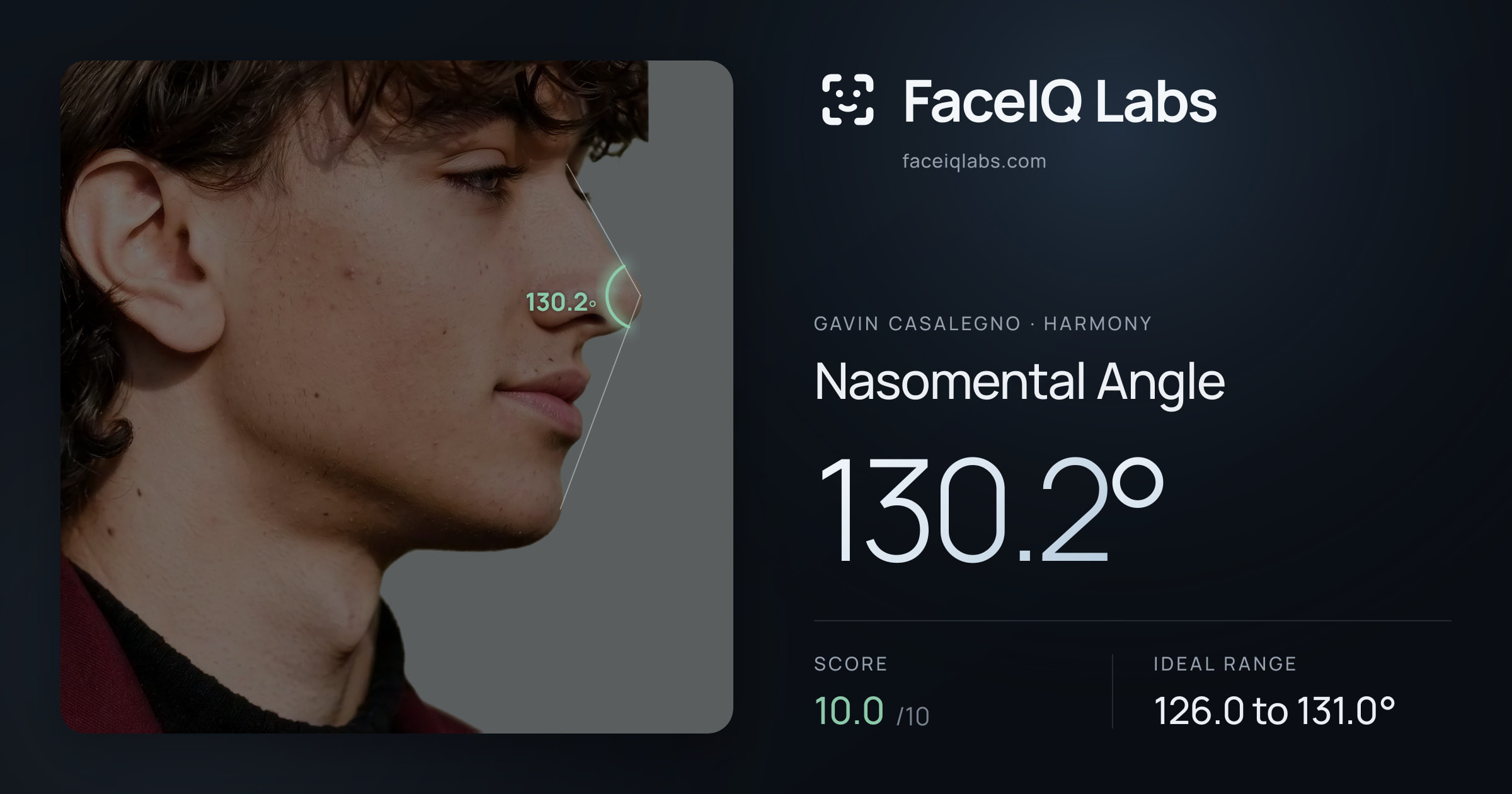 Gavin Casalegno Nasomental Angle: 130.2°, drawn on the photo