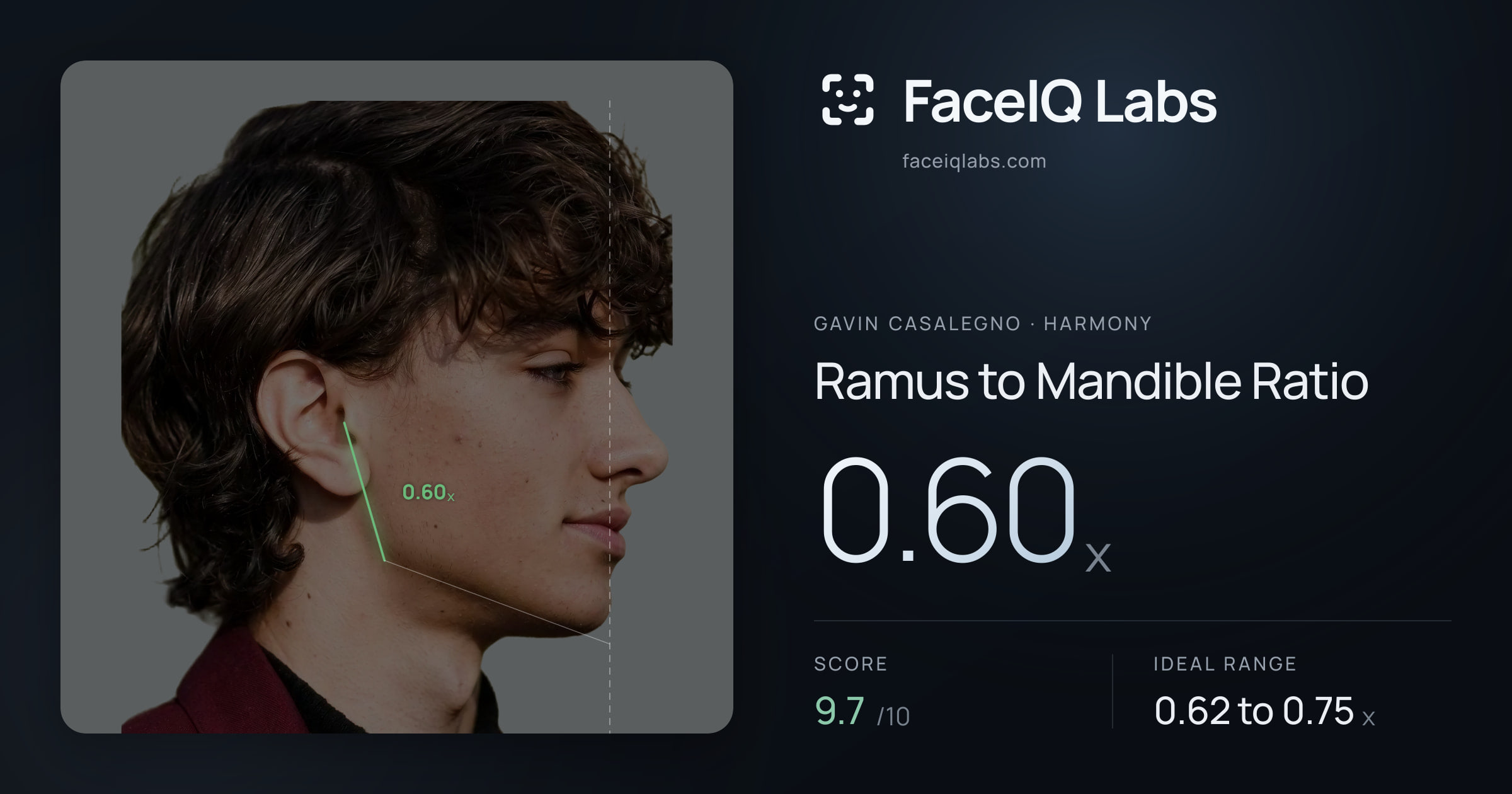 Gavin Casalegno Ramus to Mandible Ratio: 0.60x, drawn on the photo
