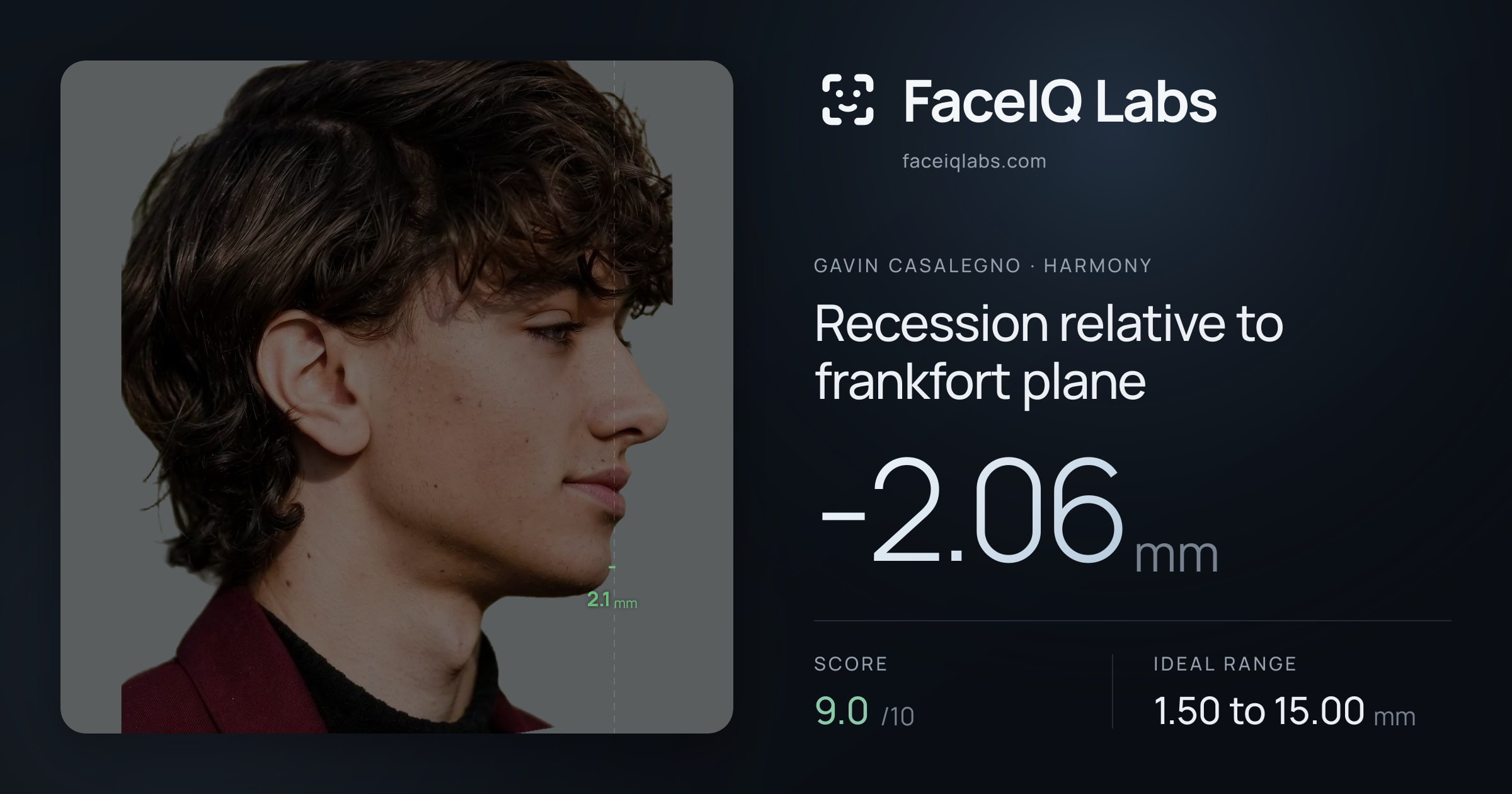 Gavin Casalegno Recession relative to frankfort plane: -2.06mm, drawn on the photo