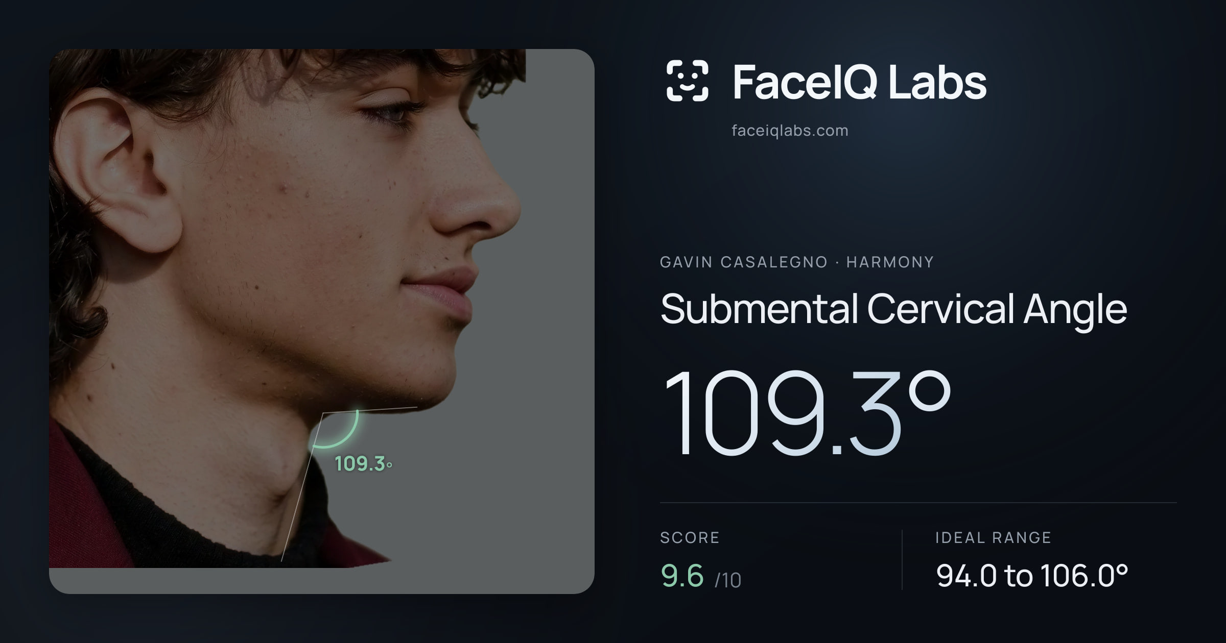 Gavin Casalegno Submental Cervical Angle: 109.3°, drawn on the photo
