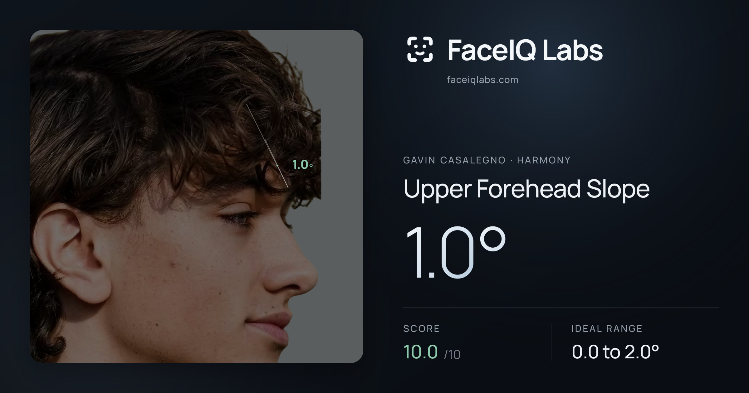 Gavin Casalegno Upper Forehead Slope: 1.0°, drawn on the photo