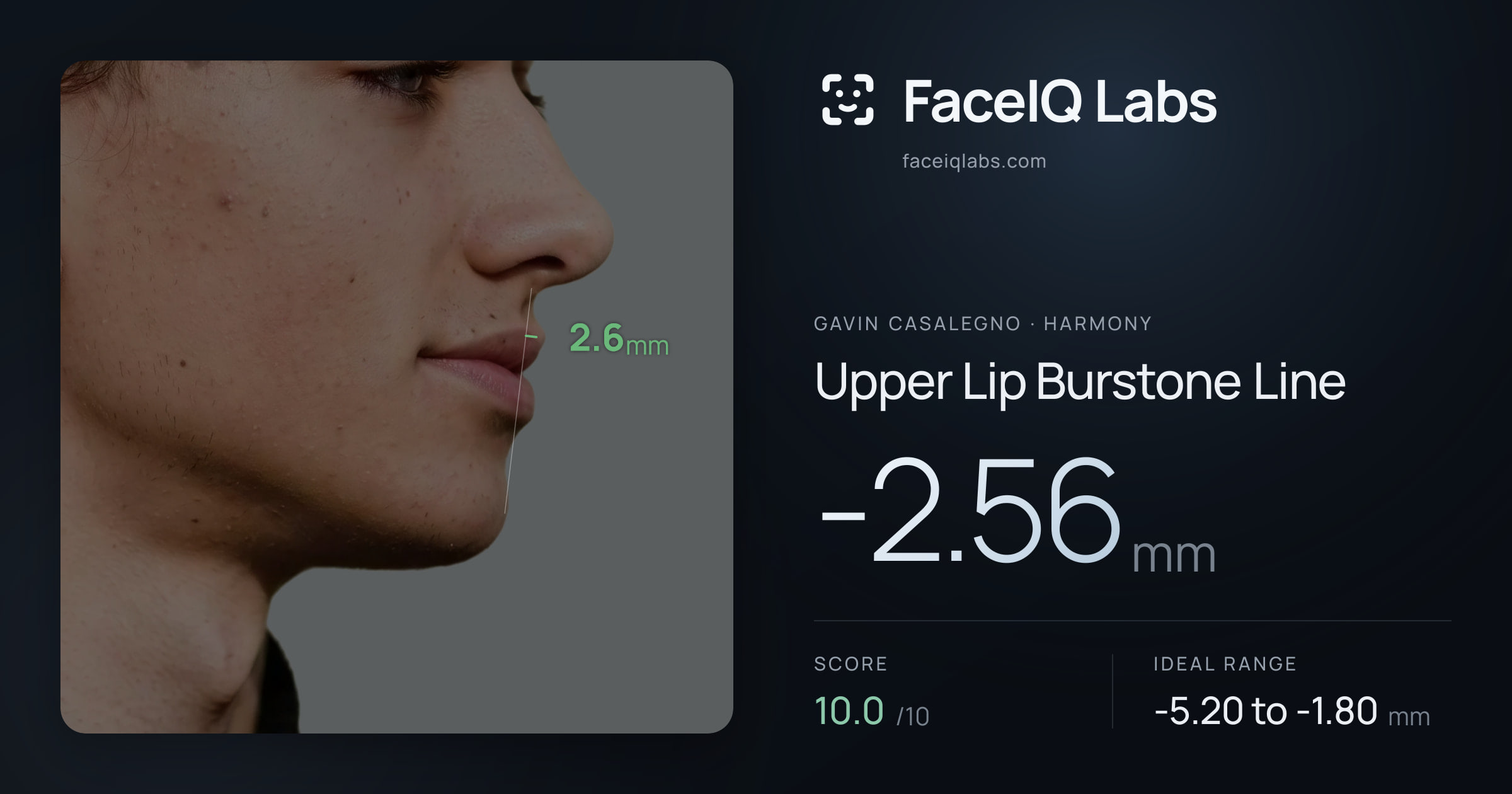 Gavin Casalegno Upper Lip Burstone Line: -2.56mm, drawn on the photo