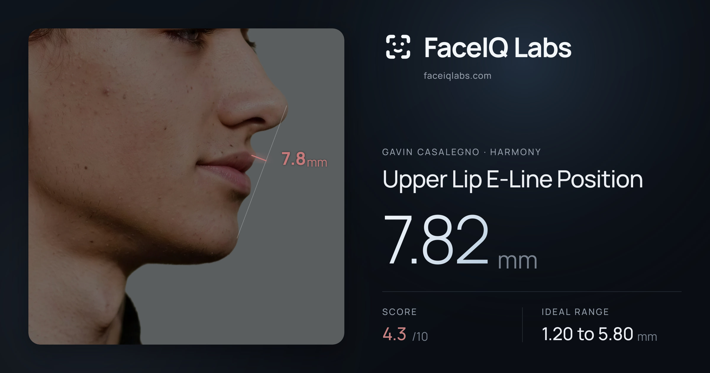 Gavin Casalegno Upper Lip E-Line Position: 7.82mm, drawn on the photo