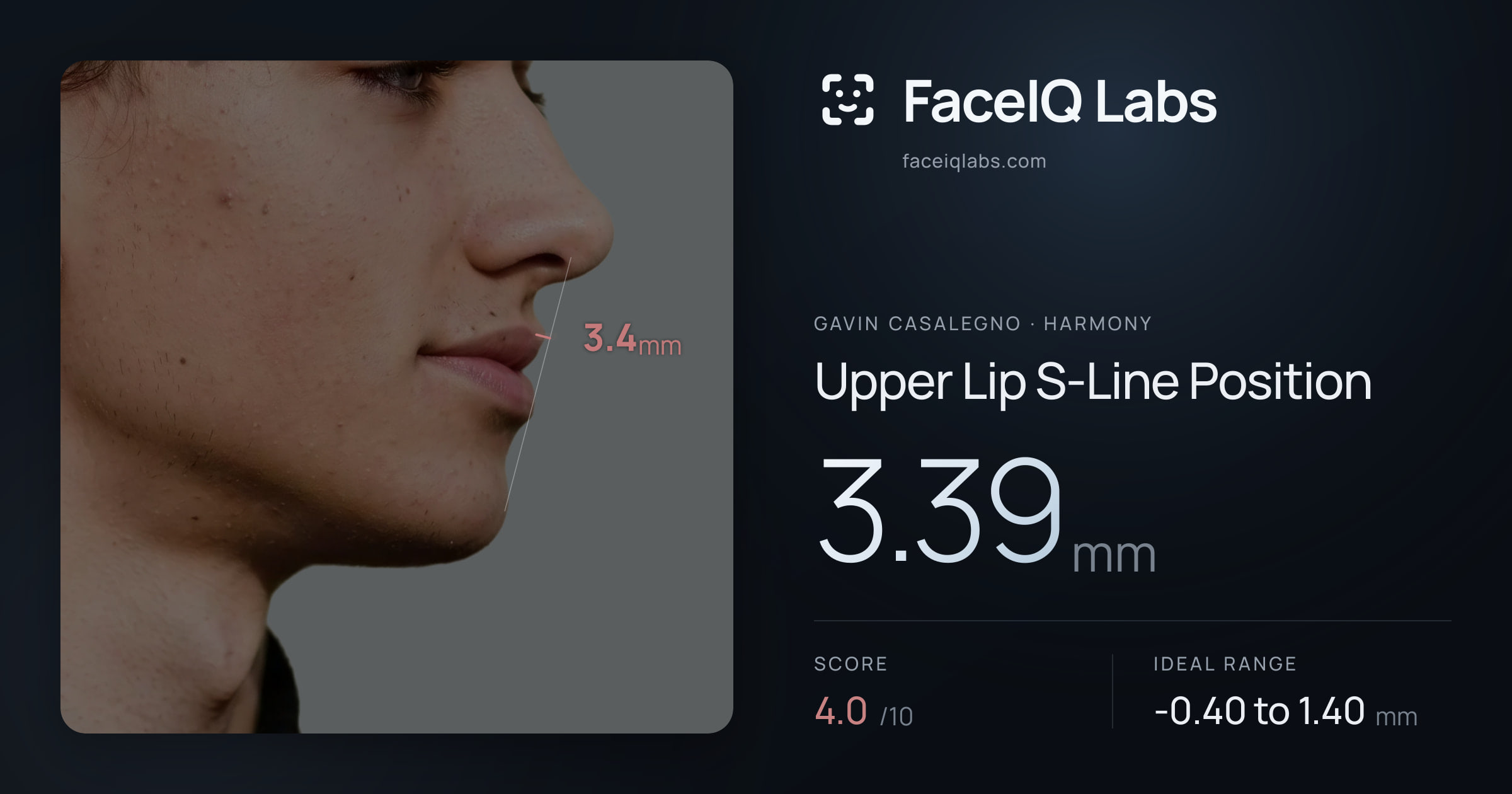 Gavin Casalegno Upper Lip S-Line Position: 3.39mm, drawn on the photo