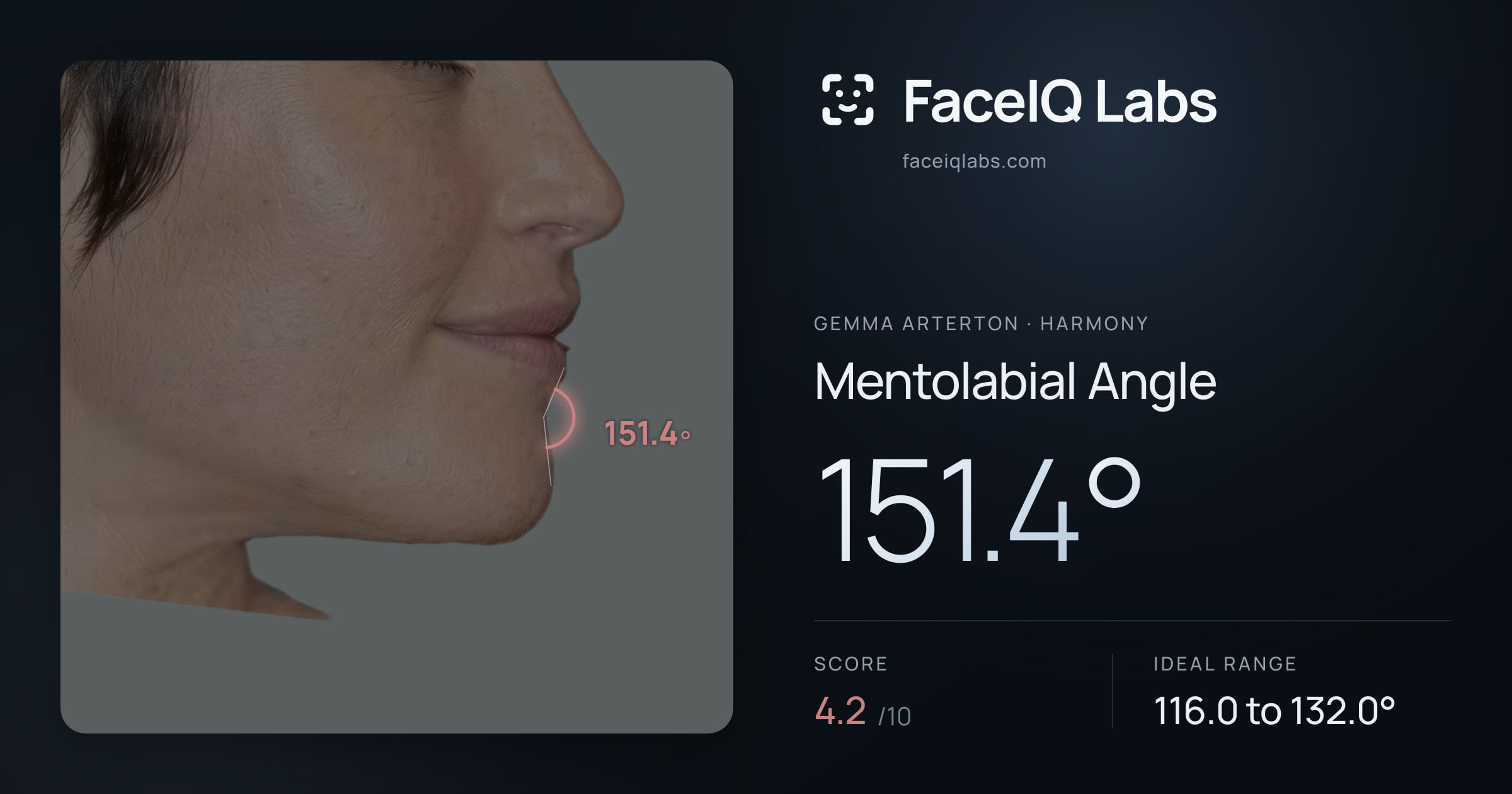 Gemma Arterton Mentolabial Angle: 151.4°, drawn on the photo