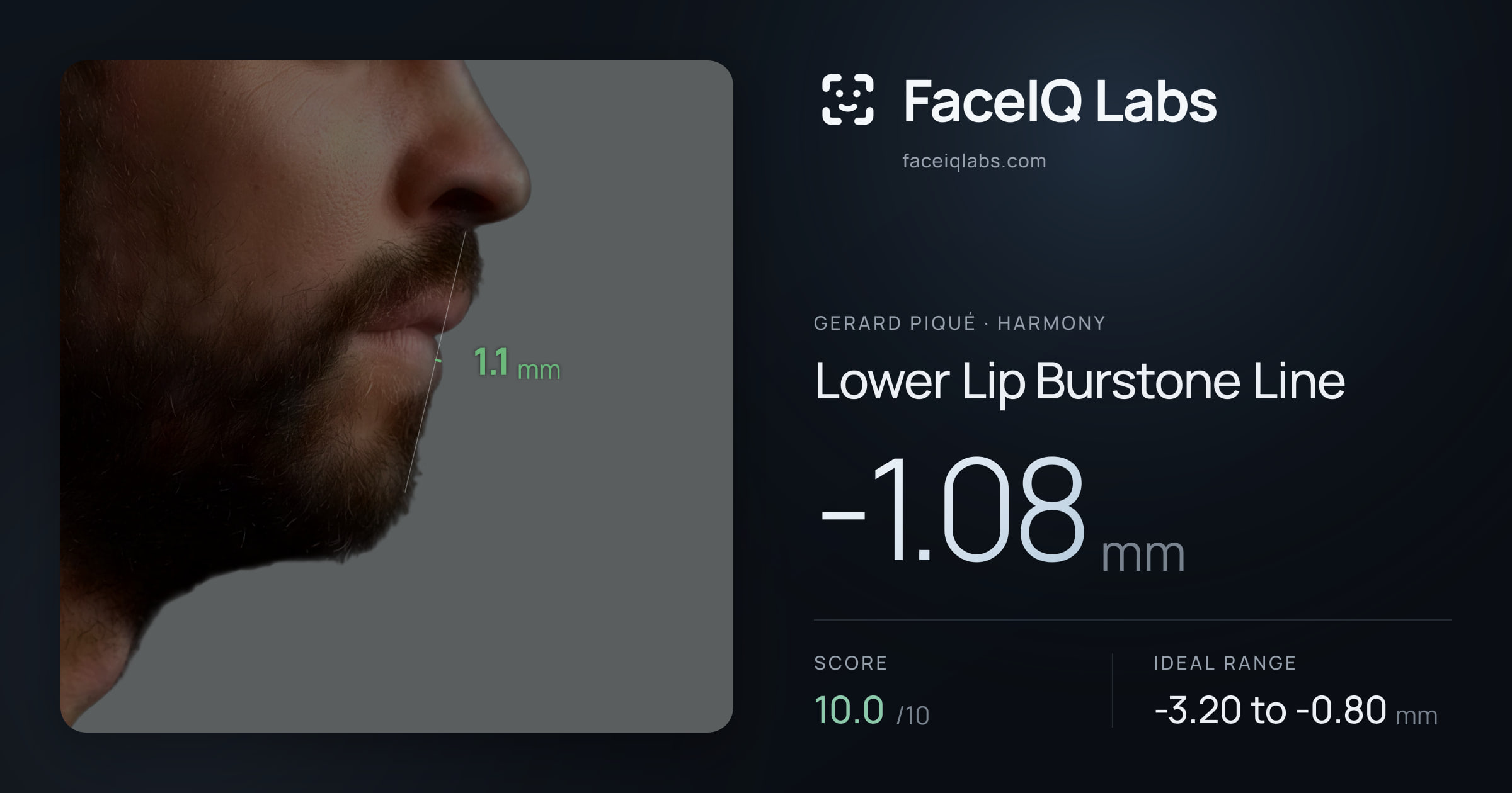 Gerard Piqué Lower Lip Burstone Line: -1.08mm, drawn on the photo