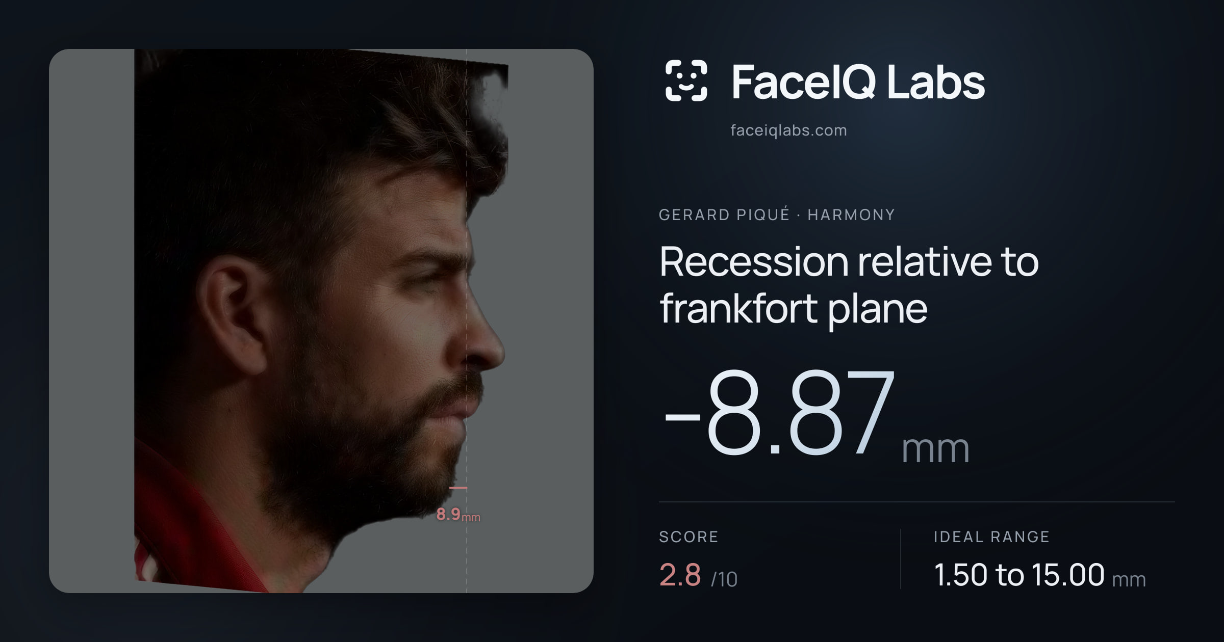 Gerard Piqué Recession relative to frankfort plane: -8.87mm, drawn on the photo
